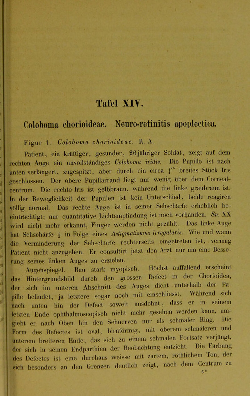 Coloboma chorioideae. Neuro-retinitis apoplectica. Figur 1. Coloboma chorioideae. R. A. Patient, ein kraftiger, gesunder, 26jähriger Soldat, zeigt auf dem rechten Auge ein unvollständiges Coloboma iridis. Die Pupille ist nach unten verlängert, zugespitzt, aber durch ein circa breites Stück Iris geschlossen. Der obere Pupillarrand liegt nur wenig über dem Corneal- centrum. Die rechte Iris ist gelbbraun, während die linke graubraun ist. In der Beweglichkeit der Pupillen ist kein Unterschied, beide reagiren völlig normal. Das rechte Auge ist in seiner Sehschärfe erheblich be- einträchtigt; nur quantitative Lichtempfindung ist noch vorhanden. Sn. XX wird nicht mehr erkannt, Finger werden nicht gezählt. Das linke Auge hat Sehschärfe \ in Folge eines Astigmatismus irregularis. Wie und wann die Verminderung der Sehschärfe rechterseits eingetreten ist, vermag Patient nicht anzugeben. Er consultirt jetzt den Arzt nur um eine Besse- rung seines linken Auges zu erzielen. Augenspiegel. Bau stark myopisch. Höchst auffallend erscheint das Hintergrundsbild durch den grossen Defect in der Chorioidea, der sich im unteren Abschnitt des Auges dicht unterhalb der Pa- pille befindet, ja letztere sogar noch mit einschliesst. Während sich nach unten hin der Defect soweit ausdehnt, dass er m seinem letzten Ende ophthalmoscopisch nicht mehr gesehen werden kann, um- fciebl er nach Oben hin den Sehnerven nur als schmaler Ring. Die Form des Defectes ist oval, birnförmig, mit oberem schmäleren und unlerem breiteren Ende, das sich zu einem schmalen Fortsatz verjüngt, der sich in seinen Endparthien der Beobachtung entzieht, D.e Färbung des Defectes ist eine durchaus weisse mit zartem, röthl.chcm Ton, der sich besonders an den Grenzen deutlich zeigt, nach dem Centrum zu