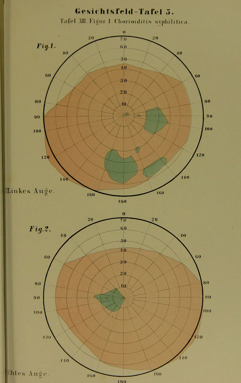 Gesichtsfeld-Tafel ö. Tafel XDT.Fi^ur l. Chorioiditis syphilitica. o I.SO