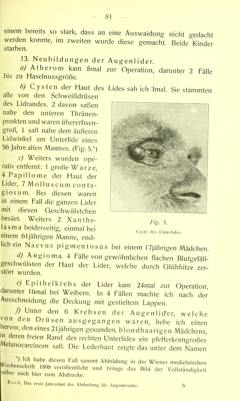 -i: • einem bereits so stark, dass an eine Auswaidung nicht gedacht werden konnte, im zweiten wurde diese gemacht. Beide\inder starben. 13. Neubildungen der Augenlider. Atherom kam 8mal zur Operation, darunter 2 Fälle bis zu Haselnussgröße. Cysten der Haut des Lides sah ich 3mal. Sie stammten alle von den Schweißdrüsen des Lidrandes. 2 davon saßen nahe den unteren Thränen- punkten und waren übererbsen- groß, 1 saß nahe dem äußeren Lidwinkel am Unterlide eines 56 Jahre alten Mannes. (Fig. 5.*) c) Weiters wurden ope- rativ entfernt: 1 große Warze, 4 Papillome der Haut der Lider, 7 M o 11 u s c u m co n ta- giosum. Bei diesen waren in einem Fall die ganzen Lider mit diesen Geschwülstchen besäet. Weiters 2 Xanthe- lasma beiderseitig, einmal bei einem 61jährigen Manne, end- lich ein Naevus pigmentosus bei einem 17jährigen Mädchen. d) Angioma. 4 Fälle von gewöhnlichen flachen Blutf^-efäß- geschwülsten der Haut der Lider, welche durch Glühhitze zer- stört wurden. Epithel krebs der Lider kam 24mal zur Operation darunter 16mal bei Weibern. In 4 Fällen machte ich nach de/ Ausschneidung die Deckung mit gestieltem Lappen. f) Unter den 6 Krebsen der Augenlider, welche von den Drüsen ausgegangen waren, hebe ich einen hervor, den eines 21 jährigen gesunden, blondhaarigen Mädchens, in deren freien Rand des rechten Unterlides ein pfefferkorngroßes' Melanocarcinom saß. Die Lederhaut zeigte das unter dem Namen *) Ich habe diesen Fall sammt Abbildung in der Wiener medicinischen Wochenschrift 1898 veröffentlicht und bringe das Bild der Vollständiokeit lalber auch hier zum Abdrucke. Bock, Das erste Jahrzehnt der Abtheilung für Augenkranke. 6 Flg. 5. Cyste des Unterlides.