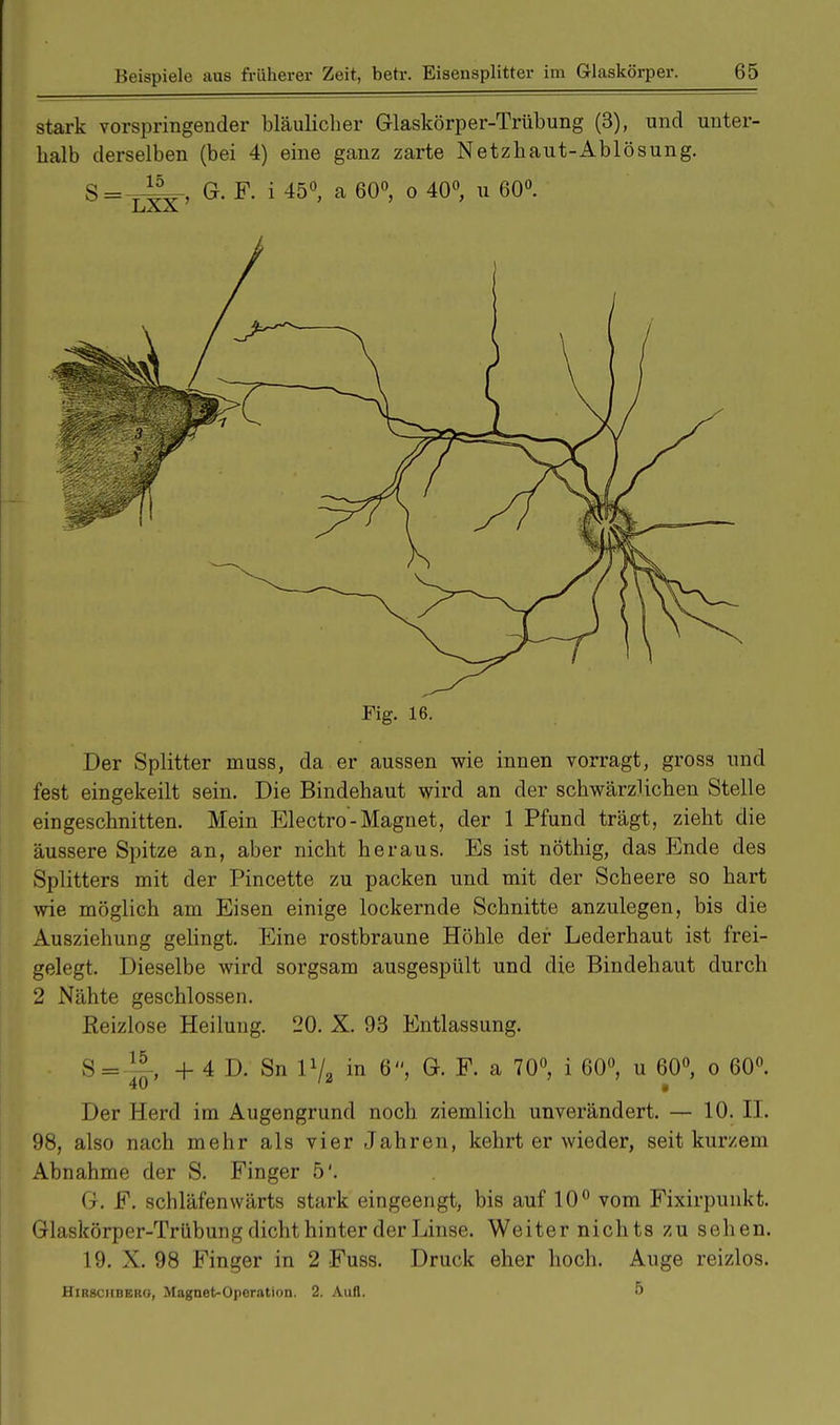 stark vorspringender bläulicher Glaskörper-Trübung (3), und unter- halb derselben (bei 4) eine ganz zarte Netzhaut-Ablösung. Fig. 16. Der Splitter muss, da er aussen wie innen vorragt, gross und fest eingekeilt sein. Die Bindehaut wird an der schwärzlichen Stelle eingeschnitten. Mein Electro-Magnet, der 1 Pfund trägt, zieht die äussere Spitze an, aber nicht heraus. Es ist nothig, das Ende des Splitters mit der Pincette zu packen und mit der Scheere so hart wie möglich am Eisen einige lockernde Schnitte anzulegen, bis die Ausziehung gelingt. Eine rostbraune Höhle der Lederhaut ist frei- gelegt, Dieselbe wird sorgsam ausgespült und die Bindehaut durch 2 Nähte geschlossen. Reizlose Heilung. 20. X. 93 Entlassung. S=-^j-, + 4 D. Sn 1V2 in 6, Gh F. a 70°, i 60°, u 60°, o 60°. Der Herd im Augengrund noch ziemlich unverändert. — 10. II. 98, also nach mehr als vier Jahren, kehrt er wieder, seit kurzem Abnahme der S. Finger 5'. G-. F. schlafenwärts stark eingeengt, bis auf 10° vom Fixirpunkt. Glaskörper-Trübung dicht hinter der Linse. Weiter nichts zu sehen. 19. X. 98 Finger in 2 Fuss. Druck eher hoch. Auge reizlos. Hirbchbero, Magnet-Operation. 2. Aufl. 5