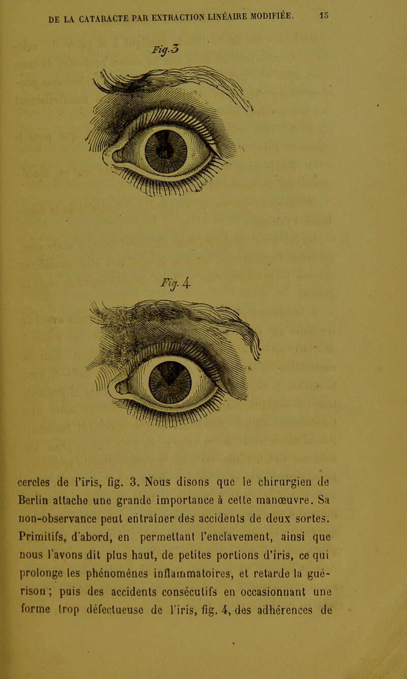 cercles de l'iris, Og. 3. Nous disons que le chirurgien de Berlin altache une grande importance à celte manœuvre. Sa non-observance peut entraîner des accidents de deux sortes. Primitifs, d'abord, en permettant l'enclavement, ainsi que nous l'avons dit plus haut, de petites portions d'iris, ce qui prolonge les phénomènes inflammatoires, et relarde la gué- rison ; puis des accidents consécutifs en occasionnant une forme trop défectueuse de Tiris, fig. 4, des adhérences de