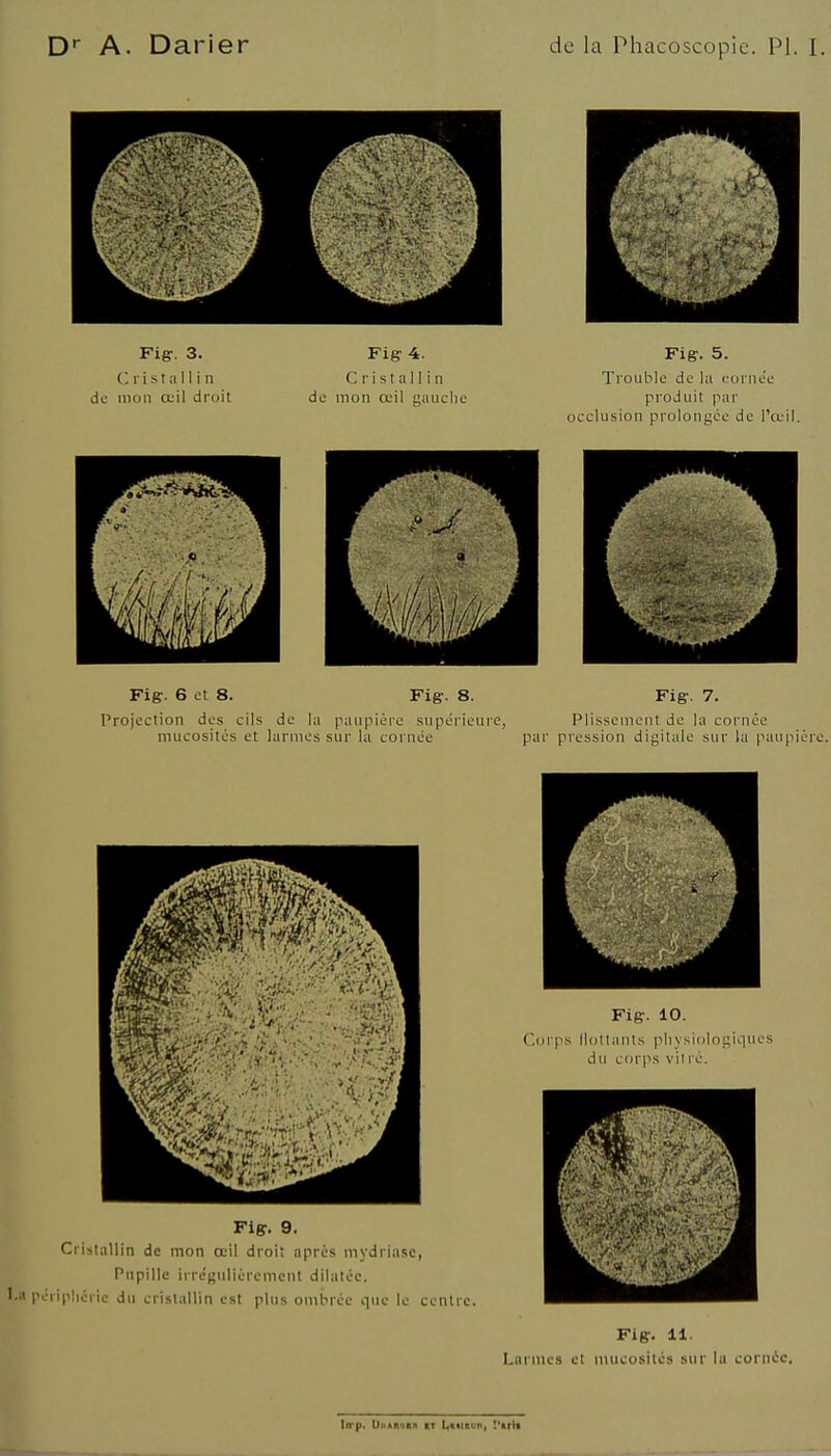 Fig:. 3. (; r i s t a 11 i n de mon ccil droit Fig 4. Cristallin de mon œil iiauclie Fig:. 5. Trouble de la cornée produit par occlusion prolongée de l'œil. Fig. 6 et 8. Fig. 8. Fig. 7. Projection des cils de la paupière supérieure, Plissement de la cornée mucosités et larmes sur la cornée par pression digitale sur la paupiér Fier. 9. Cristallin de mon œil droit après mydriasc, Pupille irrégulièrement dilatée, 'eripliéric du cristallin est plus ombrée que le centre. Fig. 10. Corps llollanls physiologiiiues du corps vil ré. Fig. 11. Larmes et mucosités sur lu cornée.