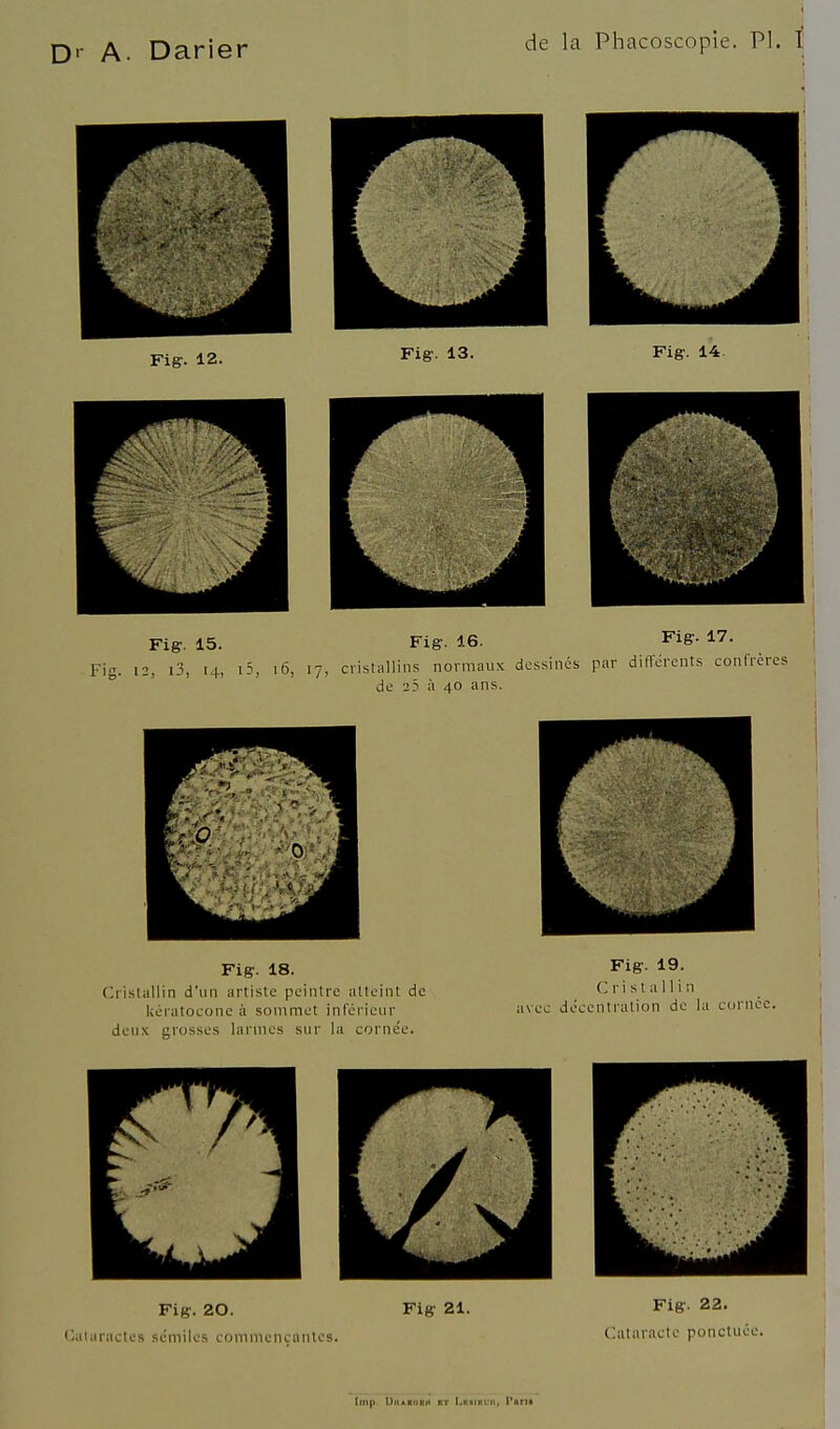 Fig. 12. Figr. 13. Fig. 14. Fig. 15. Fig. 16. Fig. 17. Fig. 12, i3, 14, i5, i6, 17, cristallins normaux dessinés par différents confrères de 23 à 40 ans. Fig. 18. (Cristallin d'un artiste peintre atteint de kératoconc à sommet infcrleur deux grosses larmes sur la corne'e. Fig. 19. Cristallin avec décentration de la cornée. Fig. 20. (jaiaractes scmilcs commençantes. Fig 21. Fig. 22. Cataracte ponctuée. Imp. UitARORii xr LxsiKUn, l'ftni