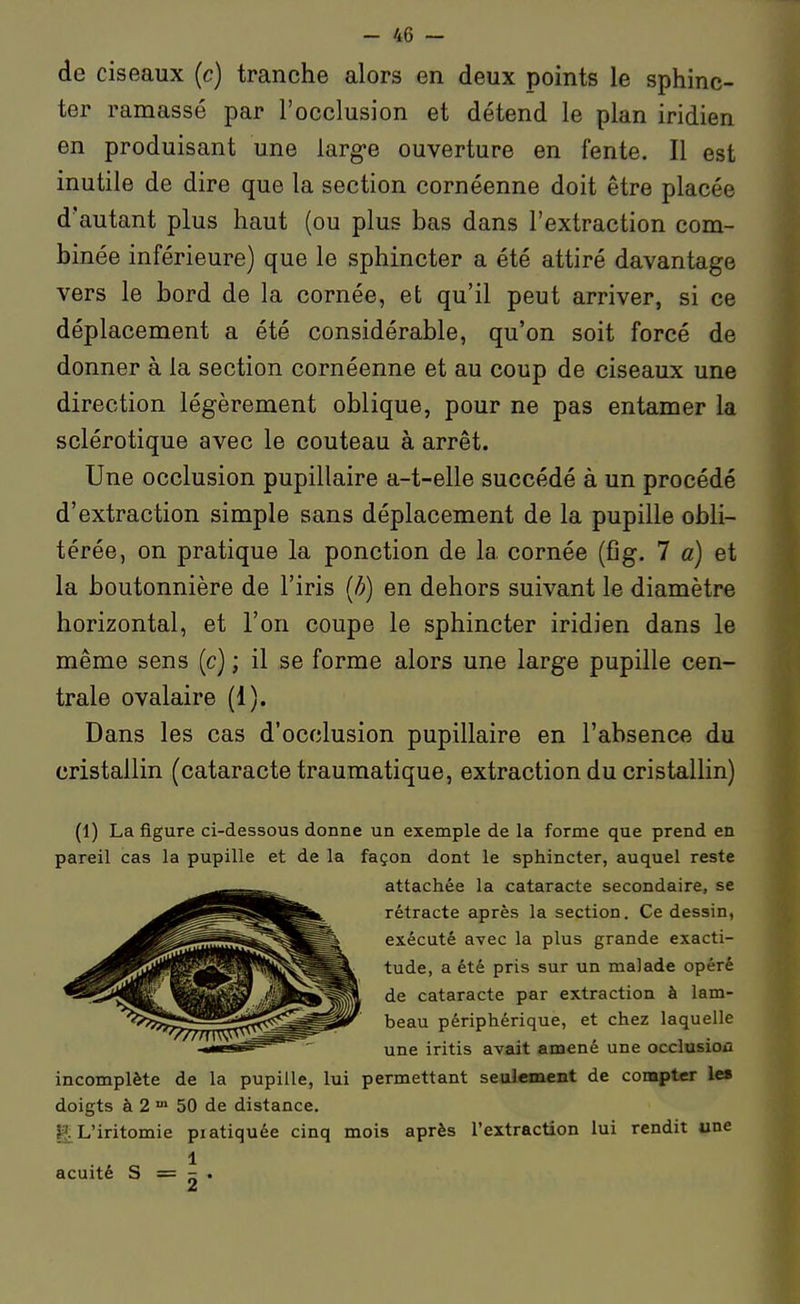 de ciseaux (c) tranche alors en deux points le sphinc- ter ramassé par l'occlusion et détend le plan iridien en produisant une larg-e ouverture en fente. Il est inutile de dire que la section cornéenne doit être placée d'autant plus haut (ou plus bas dans l'extraction com- binée inférieure) que le sphincter a été attiré davantage vers le bord de la cornée, et qu'il peut arriver, si ce déplacement a été considérable, qu'on soit forcé de donner à la section cornéenne et au coup de ciseaux une direction légèrement oblique, pour ne pas entamer la sclérotique avec le couteau à arrêt. Une occlusion pupillaire a-t-elle succédé à un procédé d'extraction simple sans déplacement de la pupille obli- térée, on pratique la ponction de la cornée (fîg. 7 a) et la boutonnière de l'iris (b) en dehors suivant le diamètre horizontal, et l'on coupe le sphincter iridien dans le même sens (c) ; il se forme alors une large pupille cen- trale ovalaire (1). Dans les cas d'occlusion pupillaire en l'absence du cristallin (cataracte traumatique, extraction du cristallin) (1) La figure ci-dessous donne un exemple de la forme que prend en pareil cas la pupille et de la façon dont le sphincter, auquel reste attachée la cataracte secondaire, se rétracte après la section. Ce dessin, exécuté avec la plus grande exacti- tude, a été pris sur un malade opéré de cataracte par extraction à lam- beau périphérique, et chez laquelle une iritis avait amené une occlusioiï incomplète de la pupille, lui permettant seulement de compter le» doigts à 2 50 de distance. g^L'iritomie piatiquée cinq mois après l'extraction lui rendit une acuité S = ^ .