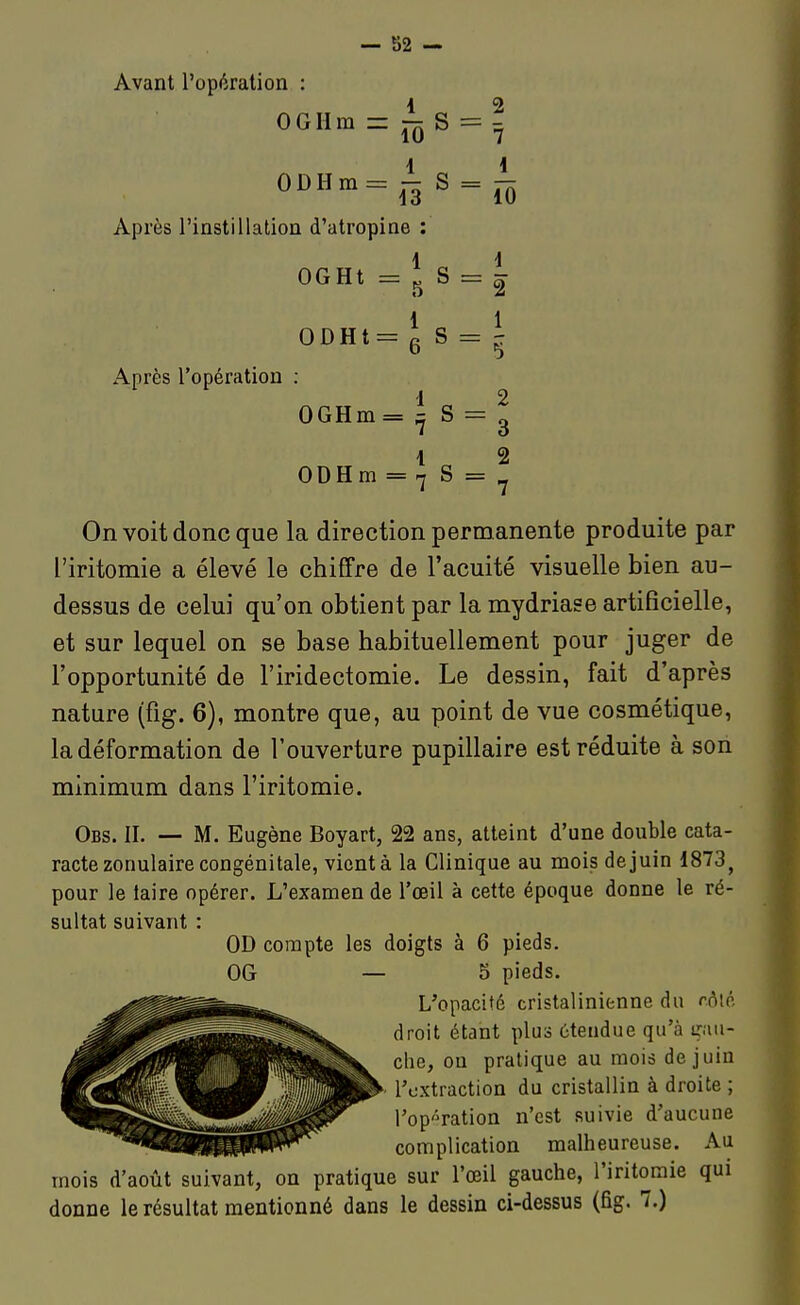 Avant l'opération : OGHm =: r;^ S 10 ODHm= ^ S Après l'instillation d'atropine : 1 Après l'opération OGHt = : S o ODHt= e s OGHm= ;j S ODHm = 7 S = 2 7 i_ 10 2 1 5 2 3 2 7 On voit donc que la direction permanente produite par l'iritomie a élevé le chiffre de l'acuité visuelle bien au- dessus de celui qu'on obtient par la mydriase artificielle, et sur lequel on se base habituellement pour juger de l'opportunité de l'iridectomie. Le dessin, fait d'après nature (fig. 6), montre que, au point de vue cosmétique, la déformation de l'ouverture pupillaire est réduite à son minimum dans l'iritomie. Obs. h. — M. Eugène Boyart, 22 ans, atteint d'une double cata- racte zonulaire congénitale, vient à la Clinique au mois de juin 1873^ pour le taire opérer. L'examen de l'œil à cette époque donne le ré- sultat suivant : OD compte les doigts à 6 pieds. OG — 5 pieds. L'opacité cristalinienne du f.ôiô droit étant plus étendue qu'à trau- che, ou pratique au mois de juin y l'extraction du cristallin à droite ; l'opération n'est suivie d'aucune complication malheureuse. Au mois d'août suivant, on pratique sur l'œil gauche, l'iritomie qui donne le résultat mentionné dans le dessin ci-dessus (fig. 7.)