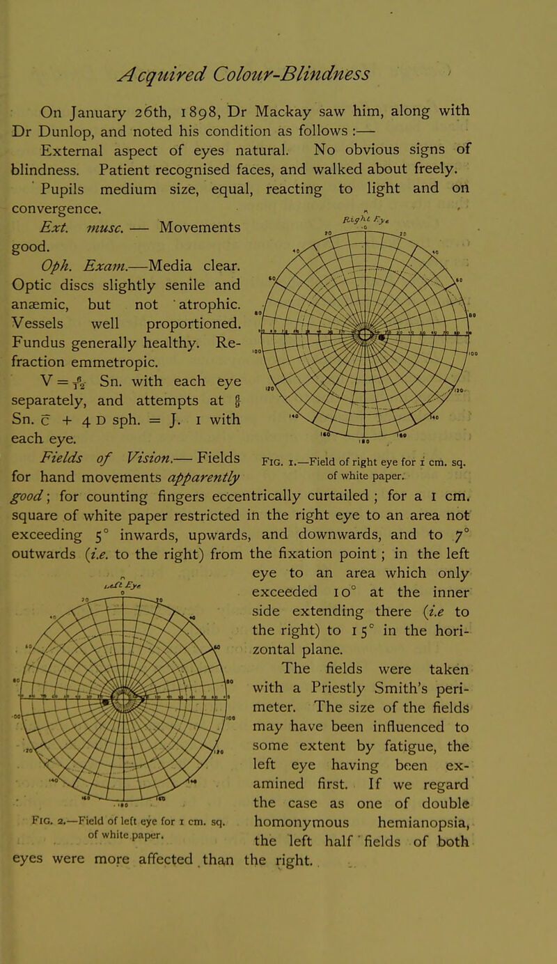 Acqtiired Colour-Blindness On January 26th, 1898, Dr Mackay saw him, along with Dr Dunlop, and noted his condition as follows :— External aspect of eyes natural. No obvious signs of blindness. Patient recognised faces, and walked about freely. Pupils medium size, equal, reacting to light and on convergence. Fig. 1.—Field of right eye for i cm. sq. of white paper. Ext. muse. — Movements good. Oph. Exam.—Media clear. Optic discs slightly senile and anaemic, but not atrophic. Vessels well proportioned. Fundus generally healthy. Re- fraction emmetropic. V = ^2 Sn. with each eye separately, and attempts at % Sn. c + 4 D sph. = J. I with each eye. Fields of Vision.— Fields for hand movements apparently good; for counting fingers eccentrically curtailed ; for a I cm. square of white paper restricted in the right eye to an area not exceeding 5° inwards, upwards, and downwards, and to 7° outwards {i.e. to the right) from the fixation point; in the left eye to an area which only exceeded 10° at the inner side extending there {i.e to the right) to i^ in the hori- zontal plane. The fields were taken with a Priestly Smith's peri- meter. The size of the fields may have been influenced to some extent by fatigue, the left eye having been ex- amined first. If we regard the case as one of double homonymous hemianopsia, the left half' fields of both Fig. 2,—Field of left eye for 1 cm. sq. of white paper. eyes were more affected tha,n the right.