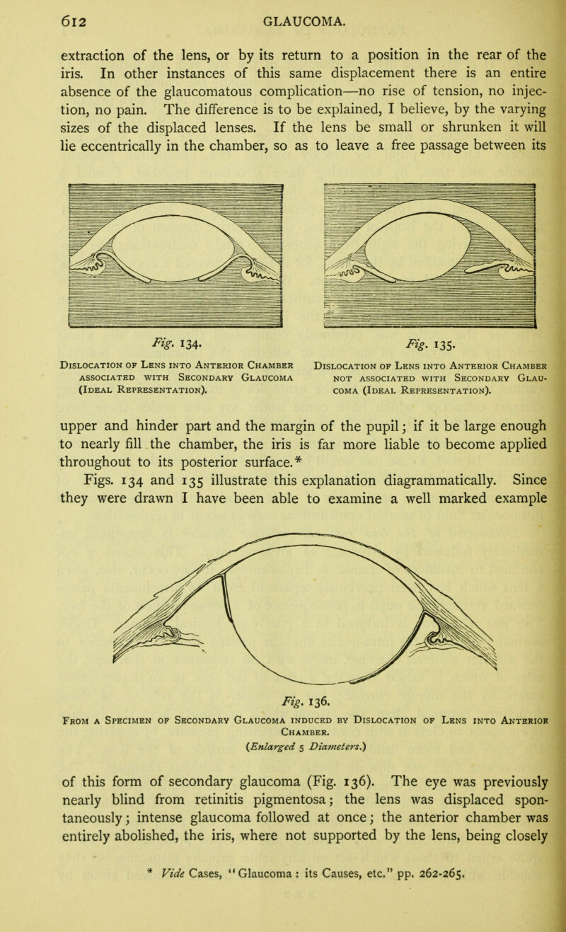 extraction of the lens, or by its return to a position in the rear of the iris. In other instances of this same displacement there is an entire absence of the glaucomatous complication—no rise of tension, no injec- tion, no pain. The difference is to be explained, I believe, by the varying sizes of the displaced lenses. If the lens be small or shrunken it will lie eccentrically in the chamber, so as to leave a free passage between its upper and hinder part and the margin of the pupil; if it be large enough to nearly fill the chamber, the iris is far more liable to become applied throughout to its posterior surface.^ Figs. 134 and 135 illustrate this explanation diagrammatically. Since they were drawn I have been able to examine a well marked example Fig, 136. From a Specimen of Secondary Glaucoma induced by Dislocation of Lens into Anterior Chamber. {^Enlarged 5 Diameters.) of this form of secondary glaucoma (Fig. 136). The eye was previously nearly blind from retinitis pigmentosa; the lens was displaced spon- taneously ; intense glaucoma followed at once; the anterior chamber was entirely abolished, the iris, where not supported by the lens, being closely Vide Cases, Glaucoma : its Causes, etc. pp. 262-265.