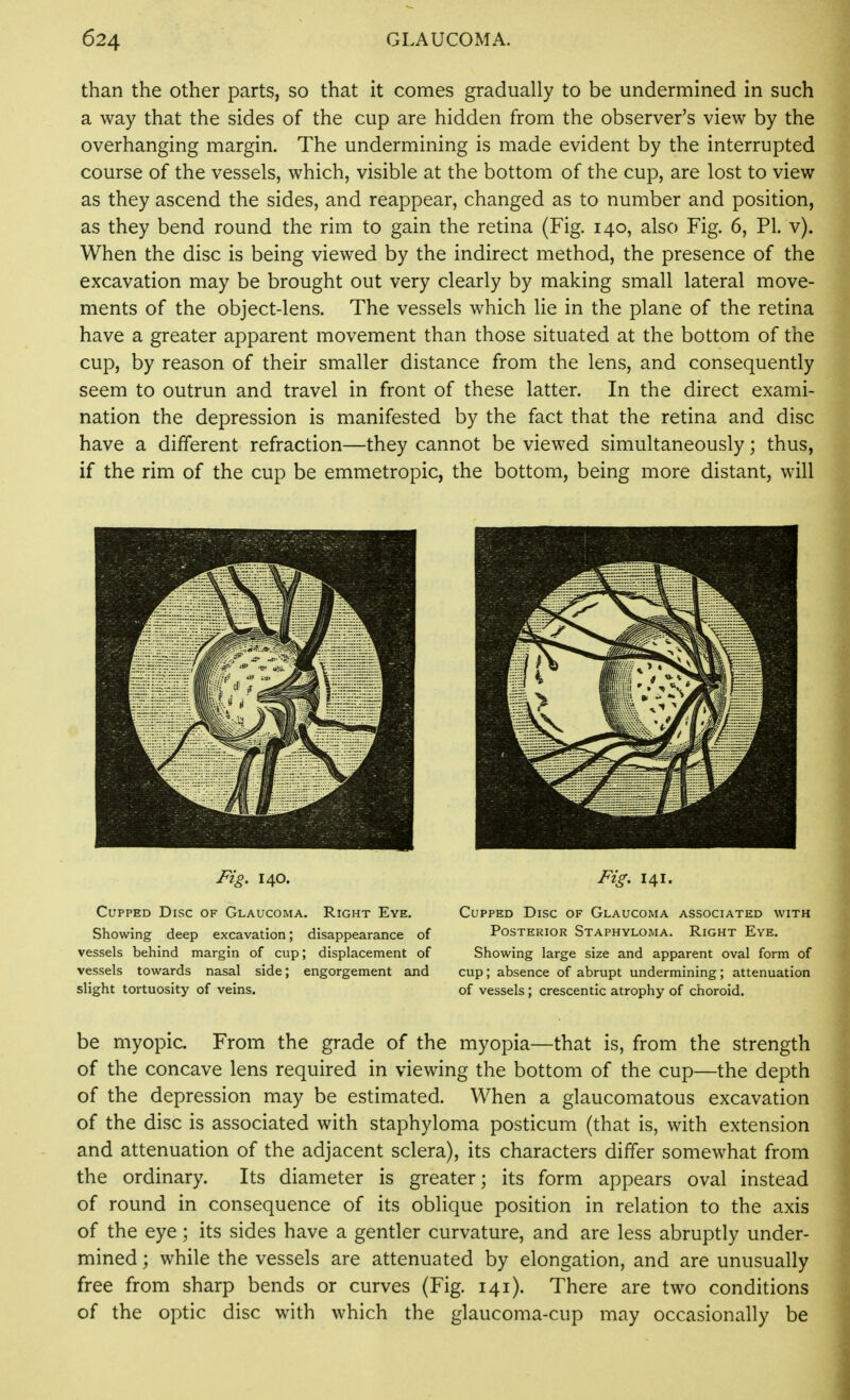 than the other parts, so that it comes gradually to be undermined in such a way that the sides of the cup are hidden from the observer's view by the overhanging margin. The undermining is made evident by the interrupted course of the vessels, which, visible at the bottom of the cup, are lost to view as they ascend the sides, and reappear, changed as to number and position, as they bend round the rim to gain the retina (Fig. 140, also Fig. 6, PI. v). When the disc is being viewed by the indirect method, the presence of the excavation may be brought out very clearly by making small lateral move- ments of the object-lens. The vessels which lie in the plane of the retina have a greater apparent movement than those situated at the bottom of the cup, by reason of their smaller distance from the lens, and consequently seem to outrun and travel in front of these latter. In the direct exami- nation the depression is manifested by the fact that the retina and disc have a different refraction—they cannot be viewed simultaneously; thus, if the rim of the cup be emmetropic, the bottom, being more distant, will Fig. 140. Cupped Disc of Glaucoma. Right Eye. Showing deep excavation; disappearance of vessels behind margin of cup; displacement of vessels towards nasal side; engorgement and slight tortuosity of veins. Fig, 141. Cupped Disc of Glaucoma associated with Posterior Staphyloma. Right Eye. Showing large size and apparent oval form of cup ; absence of abrupt undermining ; attenuation of vessels ; crescentic atrophy of choroid. be myopic. From the grade of the myopia—that is, from the strength of the concave lens required in viewing the bottom of the cup—the depth of the depression may be estimated. When a glaucomatous excavation of the disc is associated with staphyloma posticum (that is, with extension and attenuation of the adjacent sclera), its characters differ somewhat from the ordinary. Its diameter is greater; its form appears oval instead of round in consequence of its oblique position in relation to the axis of the eye; its sides have a gentler curvature, and are less abruptly under- mined ; while the vessels are attenuated by elongation, and are unusually free from sharp bends or curves (Fig. 141). There are two conditions of the optic disc with which the glaucoma-cup may occasionally be