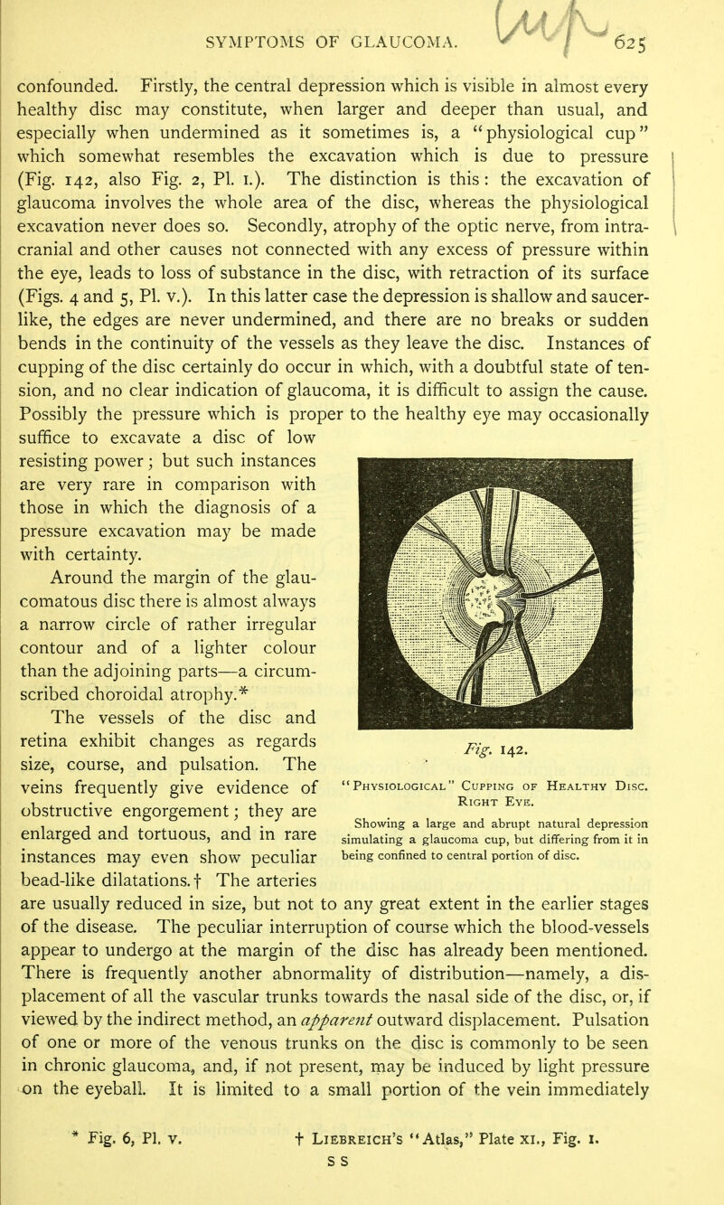confounded. Firstly, the central depression which is visible in almost every healthy disc may constitute, when larger and deeper than usual, and especially when undermined as it sometimes is, a physiological cup which somewhat resembles the excavation which is due to pressure (Fig. 142, also Fig. 2, PI. i.). The distinction is this: the excavation of glaucoma involves the whole area of the disc, whereas the physiological excavation never does so. Secondly, atrophy of the optic nerve, from intra- cranial and other causes not connected with any excess of pressure within the eye, leads to loss of substance in the disc, with retraction of its surface (Figs. 4 and 5, PI. v.). In this latter case the depression is shallow and saucer- like, the edges are never undermined, and there are no breaks or sudden bends in the continuity of the vessels as they leave the disc. Instances of cupping of the disc certainly do occur in which, with a doubtful state of ten- sion, and no clear indication of glaucoma, it is difficult to assign the cause. Possibly the pressure which is proper to the healthy eye may occasionally suffice to excavate a disc of low resisting power; but such instances are very rare in comparison with those in which the diagnosis of a pressure excavation may be made with certainty. Around the margin of the glau- comatous disc there is almost always a narrow circle of rather irregular contour and of a lighter colour than the adjoining parts—a circum- scribed choroidal atrophy.^ The vessels of the disc and retina exhibit changes as regards size, course, and pulsation. The veins frequently give evidence of obstructive engorgement; they are enlarged and tortuous, and in rare instances may even show peculiar bead-like dilatations, f The arteries are usually reduced in size, but not to any great extent in the earlier stages of the disease. The peculiar interruption of course which the blood-vessels appear to undergo at the margin of the disc has already been mentioned. There is frequently another abnormality of distribution—namely, a dis- placement of all the vascular trunks towards the nasal side of the disc, or, if viewed by the indirect method, an apparent outward displacement. Pulsation of one or more of the venous trunks on the disc is commonly to be seen in chronic glaucoma, and, if not present, may be induced by light pressure -on the eyeball. It is limited to a small portion of the vein immediately Fig. 142. Physiological Cupping of Healthy Disc. Right Eye. Showing a large and abrupt natural depression simulating a glaucoma cup, but differing from it in being confined to central portion of disc. * Fig, 6, PI. v. t Liebreich's Atlas, Plate xi., Fig. i. s s