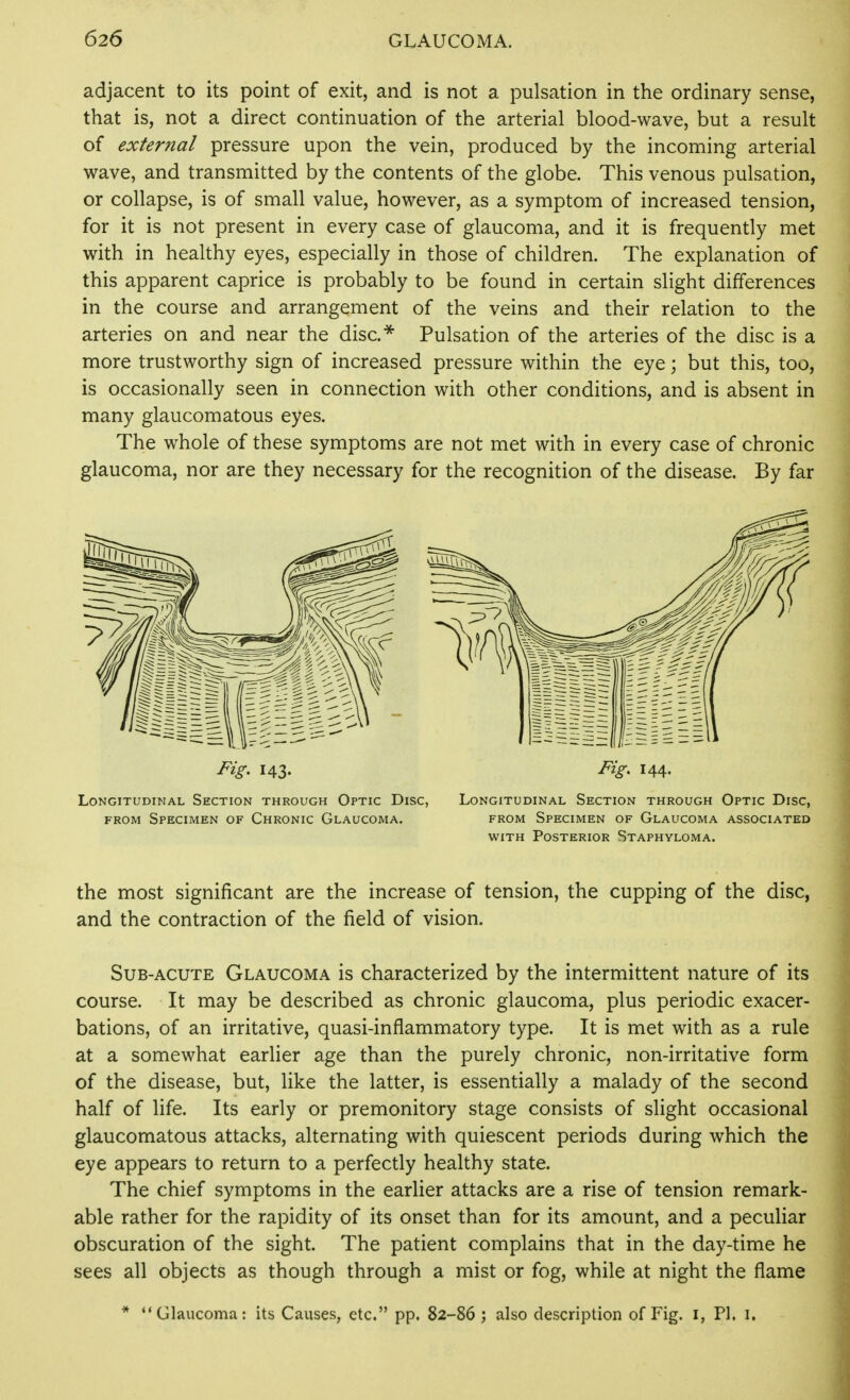 adjacent to its point of exit, and is not a pulsation in the ordinary sense, that is, not a direct continuation of the arterial blood-wave, but a result of external pressure upon the vein, produced by the incoming arterial wave, and transmitted by the contents of the globe. This venous pulsation, or collapse, is of small value, however, as a symptom of increased tension, for it is not present in every case of glaucoma, and it is frequently met with in healthy eyes, especially in those of children. The explanation of this apparent caprice is probably to be found in certain slight differences in the course and arrangement of the veins and their relation to the arteries on and near the disc.^ Pulsation of the arteries of the disc is a more trustworthy sign of increased pressure within the eye; but this, too, is occasionally seen in connection with other conditions, and is absent in many glaucomatous eyes. The whole of these symptoms are not met with in every case of chronic glaucoma, nor are they necessary for the recognition of the disease. By far Fig, 143. Fig. 144. Longitudinal Section through Optic Disc, Longitudinal Section through Optic Disc, FROM Specimen of Chronic Glaucoma. from Specimen of Glaucoma associated with Posterior Staphyloma. the most significant are the increase of tension, the cupping of the disc, and the contraction of the field of vision. Sub-acute Glaucoma is characterized by the intermittent nature of its course. It may be described as chronic glaucoma, plus periodic exacer- bations, of an irritative, quasi-inflammatory type. It is met with as a rule at a somewhat earlier age than the purely chronic, non-irritative form of the disease, but, like the latter, is essentially a malady of the second half of life. Its early or premonitory stage consists of slight occasional glaucomatous attacks, alternating with quiescent periods during which the eye appears to return to a perfectly healthy state. The chief symptoms in the earlier attacks are a rise of tension remark- able rather for the rapidity of its onset than for its amount, and a peculiar obscuration of the sight. The patient complains that in the day-time he sees all objects as though through a mist or fog, while at night the flame * Glaucoma: its Causes, etc. pp. 82-86 ; also description of Fig. i, PI, i.
