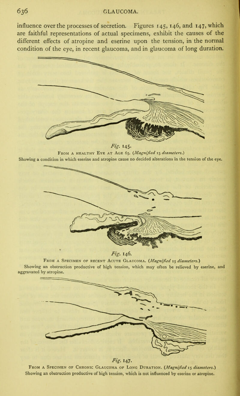 influence over the processes of secretion. Figures 145, 146, and 147, which are faithful representations of actual specimens, exhibit the causes of the different effects of atropine and eserine upon the tension, in the normal condition of the eye, in recent glaucoma, and in glaucoma of long duration. Fig. 145. From a healthy Eye at Age 65. {Magnified 15 diameters.) Showing a condition in which eserine and atropine cause no decided alterations in the tension of the eye. Fig. 146. From a Specimen of recent Acute Glaucoma. {Magnified 15 diameters.') Showing an obstruction productive of high tension, which may often be relieved by eserine, and aggravated by atropine. Fig. 147. From a Specimen of Chronic Glaucoma of Long Duration. {Magnified diameters.) Showing an obstruction productive of high tension, which is not influenced by eserine or atropine.
