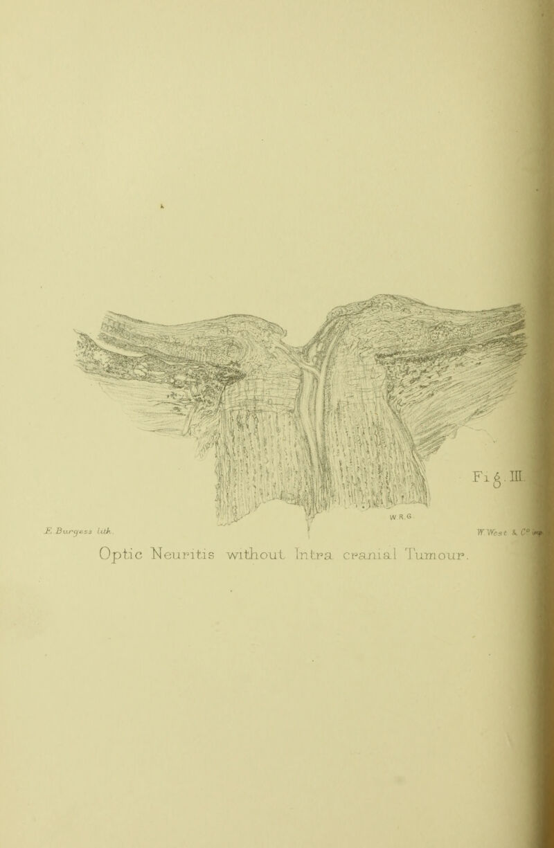 W R.6 in Optic ISfeuritis witliout Intra cpr/luxI i uinoiir.