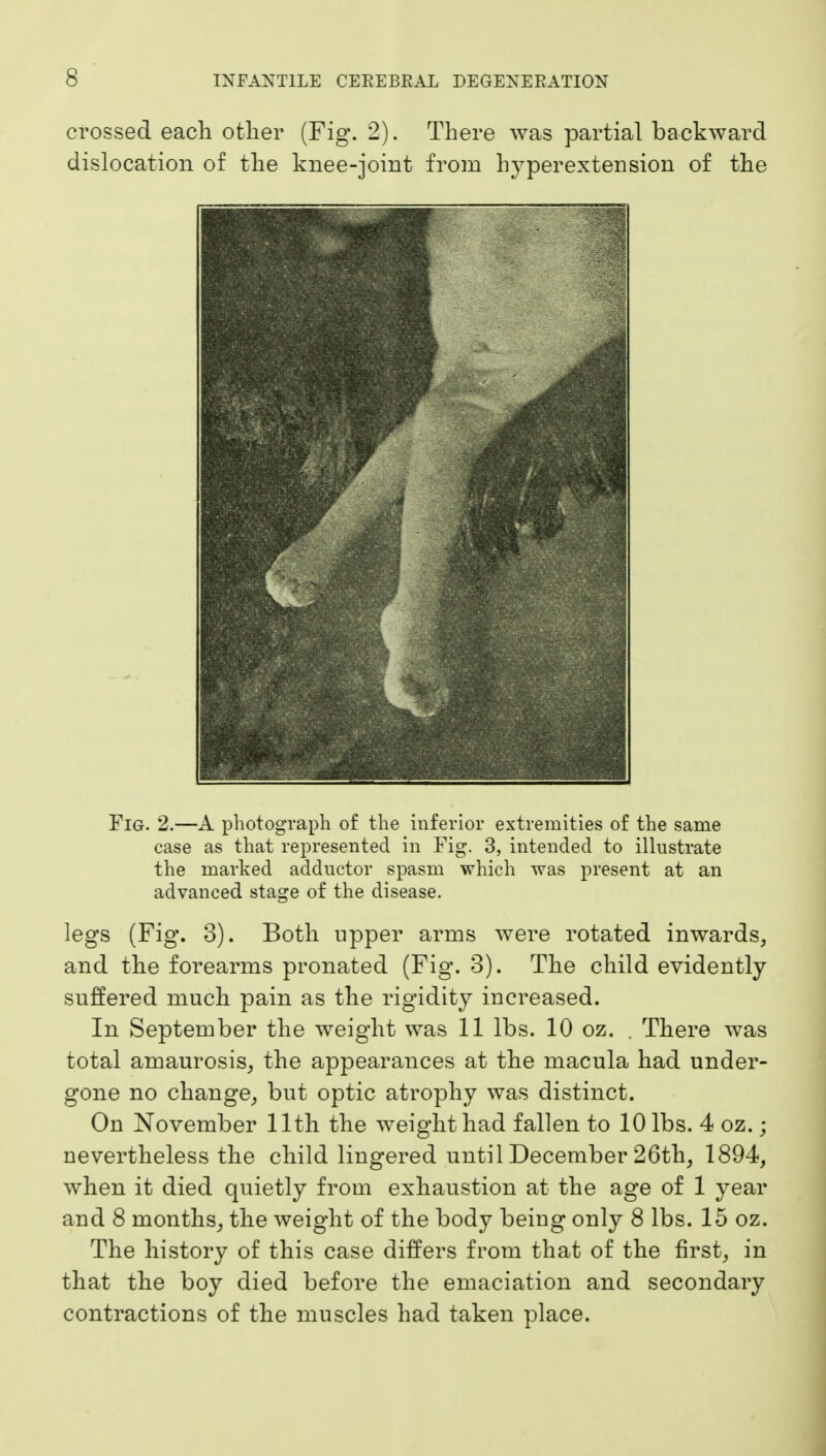 crossed each other (Fig. 2). There was partial backward dislocation of the knee-joint from hyperextension of the Fig. 2.—A photograph of the inferior extremities of the same case as that represented in Fig. 3, intended to illustrate the marked adductor spasm which was present at an advanced stage of the disease. legs (Fig. 3). Both upper arms were rotated inwards, and the forearms pronated (Fig. 3). The child evidently suffered much pain as the rigidity increased. In September the weight was 11 lbs. 10 oz. . There was total amaurosis, the appearances at the macula had under- gone no change, but optic atrophy was distinct. On November 11th the weight had fallen to 10 lbs. 4 oz.; nevertheless the child lingered until December 26th, 1894, when it died quietly from exhaustion at the age of 1 year and 8 months, the weight of the body being only 8 lbs. 15 oz. The history of this case differs from that of the first, in that the boy died before the emaciation and secondary contractions of the muscles had taken place.