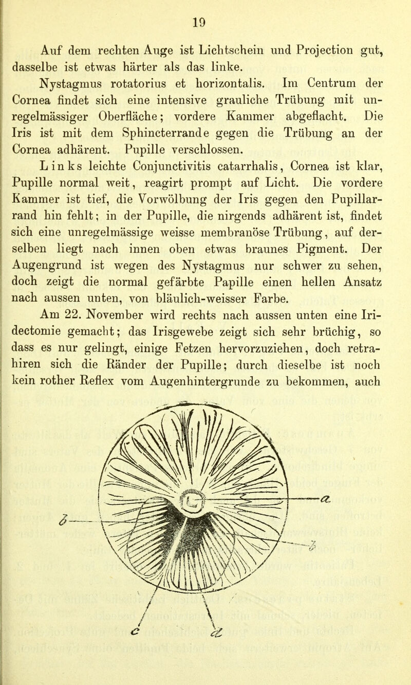 Auf dem rechten Auge ist Lichtschein und Projection gut, dasselbe ist etwas härter als das linke. Nystagmus rotatorius et liorizontalis. Im Centrum der Cornea findet sich eine intensive grauliche Trübung mit un- regelmässiger Oberfläche; vordere Kammer abgeflacht. Die Iris ist mit dem Sphincterrande gegen die Trübung an der Cornea adhärent. Pupille verschlossen. Links leichte Conjunctivitis catarrhalis, Cornea ist klar, Pupille normal vs^eit, reagirt prompt auf Licht. Die vordere Kammer ist tief, die Vorwölbung der Iris gegen den Pupillar- rand hin fehlt; in der Pupille, die nirgends adhärent ist, findet sich eine unregelmässige weisse membranöse Trübung, auf der- selben liegt nach innen oben etwas braunes Pigment. Der Augengrund ist wegen des Nystagmus nur schwer zu sehen, doch zeigt die normal gefärbte Papille einen hellen Ansatz nach aussen unten, von bläulich-weisser Farbe. Am 22. November wird rechts nach aussen unten eine Iri- dectomie gemacht; das Irisgewebe zeigt sich sehr brüchig, so dass es nur gelingt, einige Fetzen hervorzuziehen, doch retra- hiren sich die Ränder der Pupille; durch dieselbe ist noch kein rother Reflex vom Augenhintergrunde zu bekommen, auch