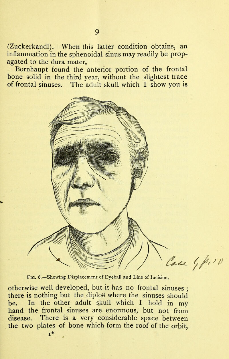 CZuckerkandl). When this latter condition obtains, an inflammation in the sphenoidal sinus may readily be prop- agated to the dura mater. Bornhaupt found the anterior portion of the frontal bone solid in the third year, without the slightest trace of frontal sinuses. The adult skull which I show you is Fig. 6.—Showing Displacement of Eyeball and Line of Incision. Otherwise well developed, but it has no frontal sinuses ; there is nothing but the diploe where the sinuses should be. In the other adult skull which I hold in my hand the frontal sinuses are enormous, but not from disease. There is a very considerable space between the two plates of bone which form the roof of the orbit,