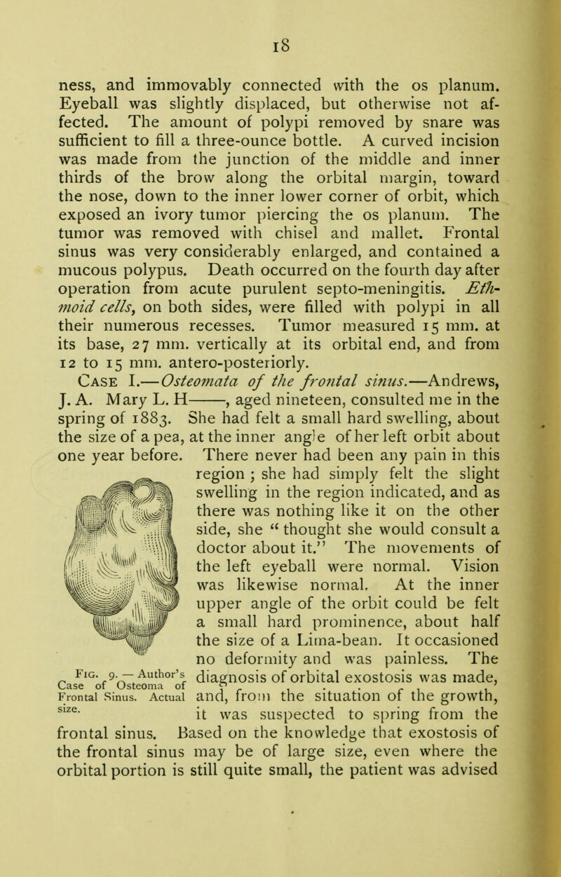 ness, and immovably connected with the os planum. Eyeball was slightly displaced, but otherwise not af- fected. The amount of polypi removed by snare was sufficient to fill a three-ounce bottle. A curved incision was made from the junction of the middle and inner thirds of the brow along the orbital margin, toward the nose, down to the inner lower corner of orbit, which exposed an ivory tumor piercing the os planum. The tumor was removed with chisel and mallet. Frontal sinus was very considerably enlarged, and contained a mucous polypus. Death occurred on the fourth day after operation from acute purulent septo-meningitis. Efh- moid cellSf on both sides, were filled with polypi in all their numerous recesses. Tumor measured 15 mm. at its base, 27 mm. vertically at its orbital end, and from 12 to 15 mm. antero-posteriorly. Case I.— Osteomata of the frofital sifiiis.—Andrews, J. A. Mary L. H , aged nineteen, consulted me in the spring of 1883. She had felt a small hard swelling, about the size of a pea, at the inner angle of her left orbit about one year before. There never had been any pain in this region ; she had simply felt the slight swelling in the region indicated, and as there was nothing like it on the other side, she  thought she would consult a doctor about it. The movements of the left eyeball were normal. Vision was likewise normal. At the inner upper angle of the orbit could be felt a small hard prominence, about half the size of a Lima-bean. It occasioned no deformity and was painless. The Fig. 9— Author's diagnosis of Orbital exostosis was made. Case of Osteoma of ^ . . ' Frontal Sinus. Actual and, trom the Situation 01 the growth, it was suspected to spring from the frontal sinus. Based on the knowledge that exostosis of the frontal sinus may be of large size, even where the orbital portion is still quite small, the patient was advised