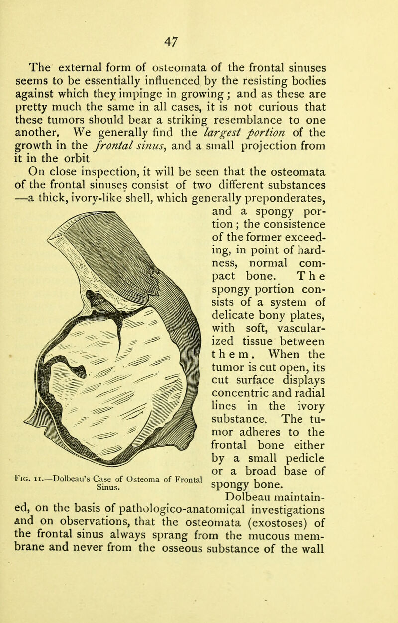 The external form of osleomata of the frontal sinuses seems to be essentially influenced by the resisting bodies against which they impinge in growing; and as these are pretty much the same in all cases, it is not curious that these tumors should bear a striking resemblance to one another. We generally find the largest portion of the growth in the frontal sinus^ and a small projection from it in the orbit On close inspection, it will be seen that the osteomata of the frontal sinuses consist of two different substances —a thick, ivory-like shell, which generally preponderates, and a spongy por- tion ; the consistence of the former exceed- ing, in point of hard- ness, normal com- pact bone. The spongy portion con- sists of a system of delicate bony plates, with soft, vascular- ized tissue between them. When the tumor is cut open, its cut surface displays concentric and radial lines in the ivory substance. The tu- mor adheres to the frontal bone either by a small pedicle or a broad base of spongy bone. Dolbeau maintain- ed, on the basis of pathologico-anatomical investigations and on observations, that the osteomata (exostoses) of the frontal sinus always sprang from the mucous mem- brane and never from the osseous substance of the wall -Dolbeau's Case of Osteoma of Frontal Sinus.