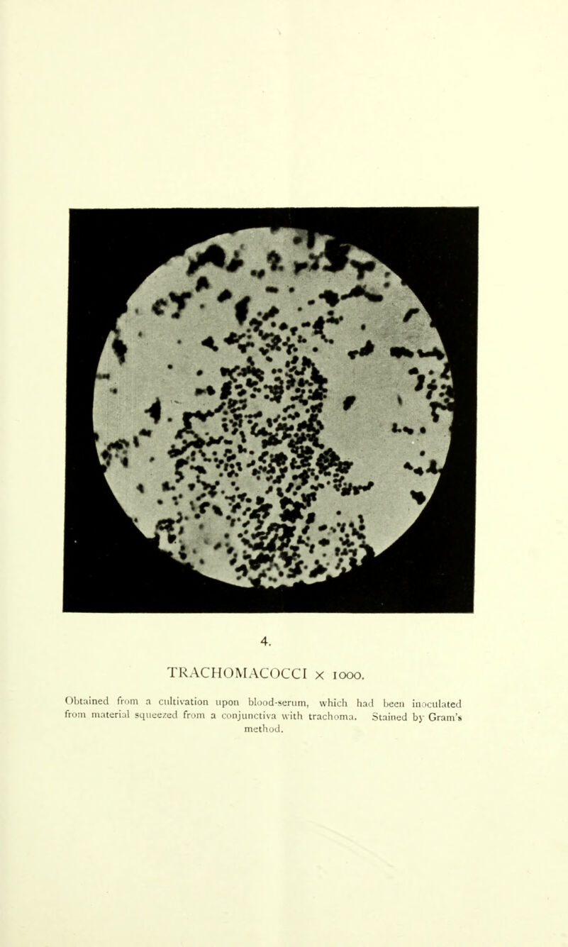 Obtained from a cultivation upon blood-serum, which had been inoculated from material squeezed from a conjunctiva with trachoma. Stained by Gram's method.