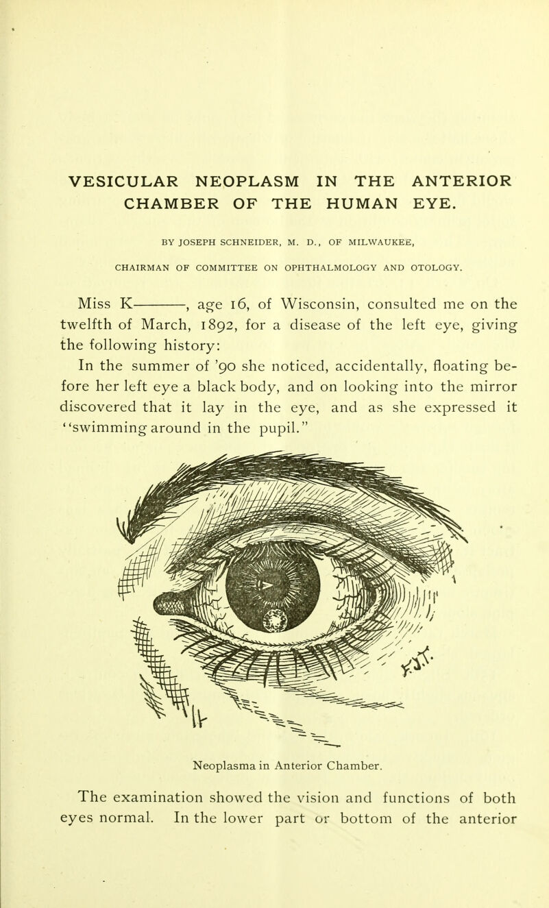 CHAMBER OF THE HUMAN EYE. BY JOSEPH SCHNEIDER, M. D., OF MILWAUKEE, CHAIRMAN OF COMMITTEE ON OPHTHALMOLOGY AND OTOLOGY. Miss K , age i6, of Wisconsin, consulted me on the twelfth of March, 1892, for a disease of the left eye, giving the following history: In the summer of '90 she noticed, accidentally, floating be- fore her left eye a black body, and on looking into the mirror discovered that it lay in the eye, and as she expressed it ''swimming around in the pupil. Neoplasma in Anterior Chamber. The examination showed the vision and functions of both eyes normal. In the lower part or bottom of the anterior