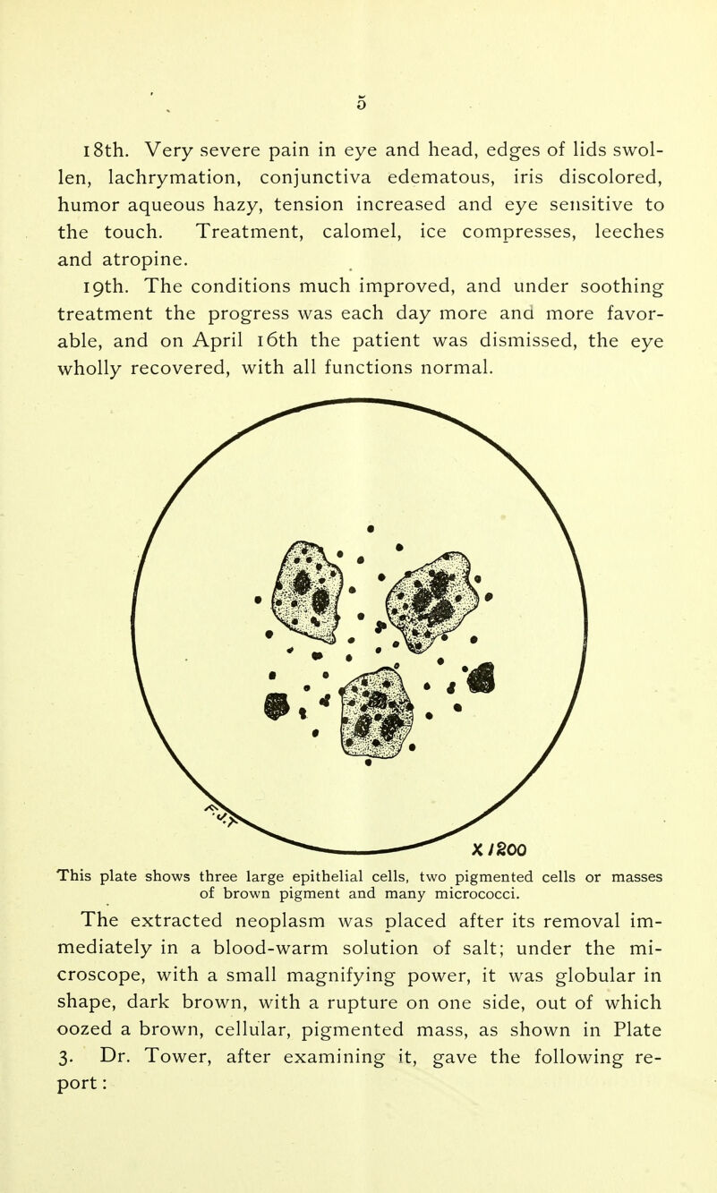 18th. Very severe pain in eye and head, edges of lids swol- len, lachrymation, conjunctiva edematous, iris discolored, humor aqueous hazy, tension increased and eye sensitive to the touch. Treatment, calomel, ice compresses, leeches and atropine. 19th. The conditions much improved, and under soothing treatment the progress was each day more ana more favor- able, and on April i6th the patient was dismissed, the eye wholly recovered, with all functions normal. This plate shows three large epithelial cells, two pigmented cells or masses of brown pigment and many micrococci. The extracted neoplasm was placed after its removal im- mediately in a blood-warm solution of salt; under the mi- croscope, with a small magnifying power, it was globular in shape, dark brown, with a rupture on one side, out of which oozed a brown, cellular, pigmented mass, as shown in Plate 3. Dr. Tower, after examining it, gave the following re- port :