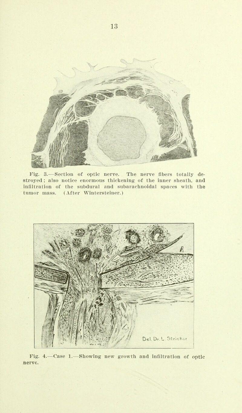 Pig. 3.—h>ccti(jn of optic nerve. The nerve fibers totally de- stroyed ; also notice enormous thickening of the inner sheath, and infiltration of the subdural and subarachnoidal spaces with the tumor mass. (After Wintersteiner.) Fig. 4.—Case 1.—Showing new growth and infiltration of optic nerve.