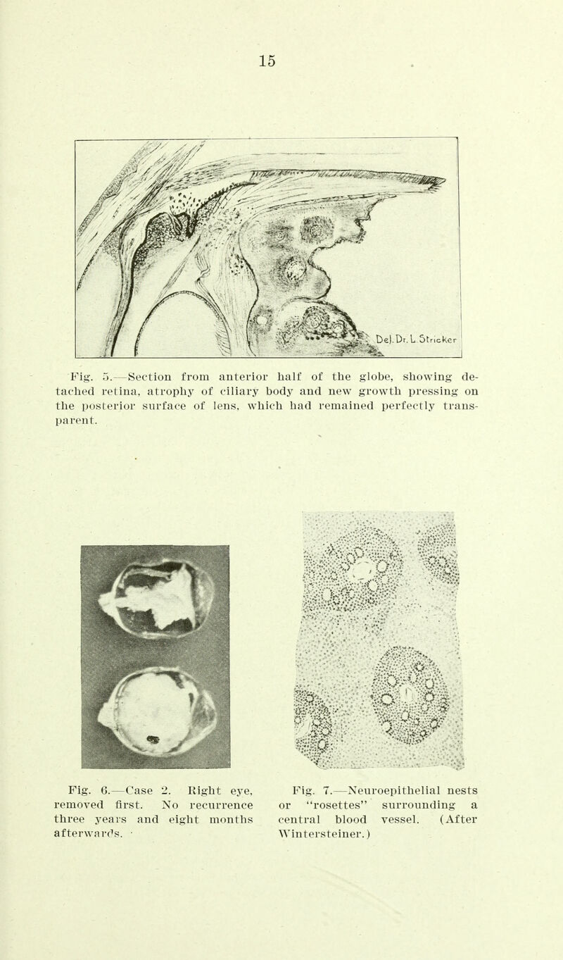 Fig. 5.—Section from anterior lialf of tlie globe, sfiowing de- taclied retina, atropliy of ciliary body and new growtli pressing on tlie posterior surface of lens, whicti had remained perfectly trans- parent. Fig. 6.—Case 2. Right eye, removed first. No recurrence three years and eight months afterwards. ■ Fig. 7.—Neuroepithelial nests or rosettes surrounding a central blood vessel. (After Wintersteiner.)