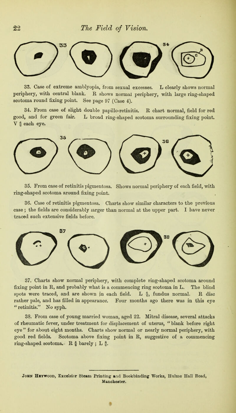 33. Case of extreme amblyopia, from sexual excesses. L clearly shows normal periphery, with central blank. R shows normal periphery, with large ring-shaped scotoma round fixing point. See page 97 (Case 4). 34. From case of slight double papillo-retinitis. R chart normal, field for red good, and for green fair. L broad ring-shaped scotoma surrounding fixing point. V f each eye. 35. From case of retinitis pigmentosa. Shows normal periphery of each field, with ring-shaped scotoma around fixing point. 36. Case of retinitis pigmentosa. Charts show similar characters to the previous case ; the fields are considerably larger than normal at the upper part. I have never traced such extensive fields before. 57 0(D 37. Charts show normal periphery, with complete ring-shaped scotoma around fixing point in R, and probably what is a commencing ring scotoma in L. The blind spots were traced, and are shown in each field. L f, fundus normal. R disc rather pale, and has filled in appearance. Four months ago there was in this eye retinitis. No syph. 38. From case of young married woman, aged 22. Mitral disease, several attacks of rheumatic fever, under treatment for displacement of uterus,  blank before right eye  for about eight months. Charts show normal or nearly normal periphery, with good red fields. Scotoma above fixing point in R, suggestive of a commencing ring-shaped scotoma. R f barely ; L |. John HirwooD, Excelsior Steam Printing and Bookbinding Works, Hulme Hall Road, Manchester.