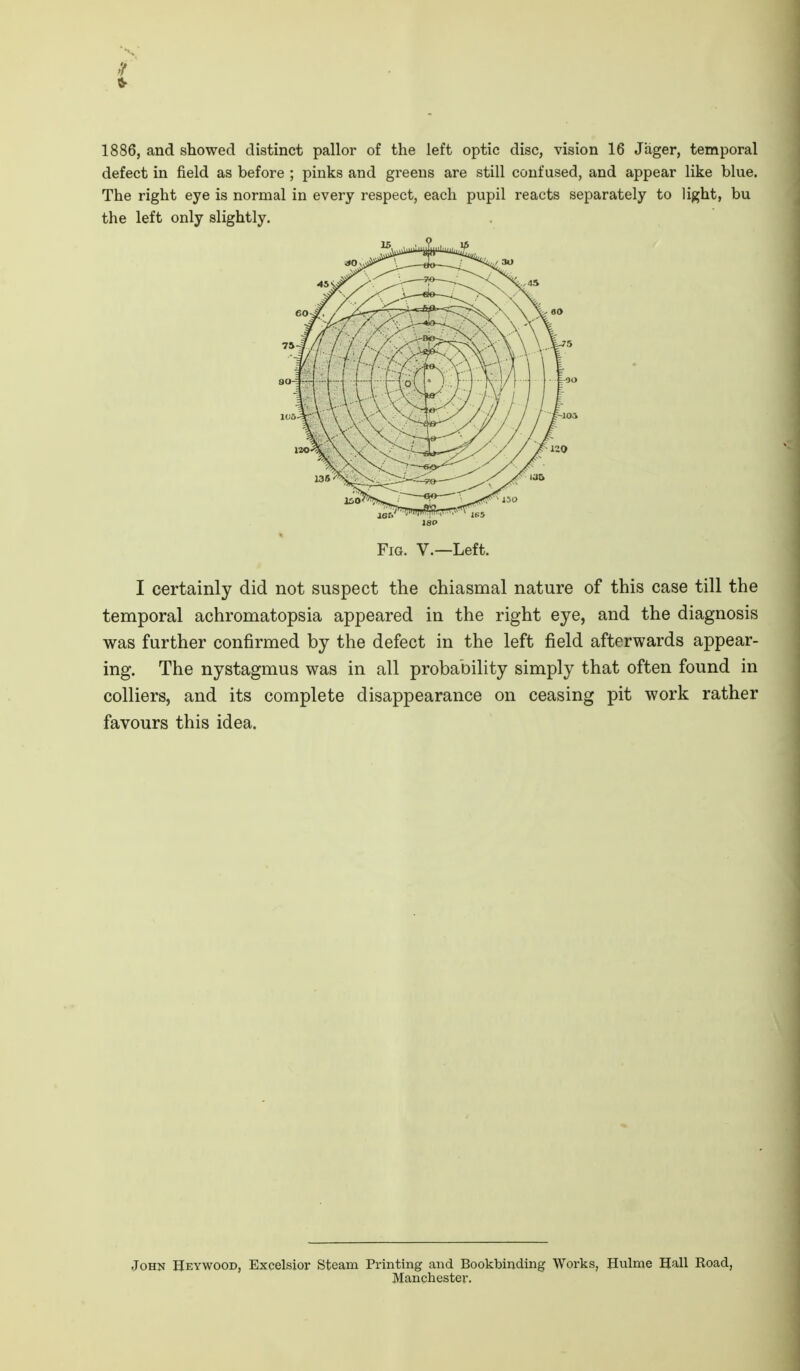 1886, and showed distinct pallor of the left optic disc, vision 16 Jager, temporal defect in field as before ; pinks and greens are still confused, and appear like blue. The right eye is normal in every respect, each pupil reacts separately to light, bu the left only slightly. Fig. v.—Left. I certainly did not suspect the chiasmal nature of this case till the temporal achromatopsia appeared in the right eye, and the diagnosis was further confirmed by the defect in the left field afterwards appear- ing. The nystagmus was in all probability simply that often found in colliers, and its complete disappearance on ceasing pit work rather favours this idea. John Heywood, Excelsior Steam Printing and Bookbinding Works, Hulme Hall Koad, Manchester.