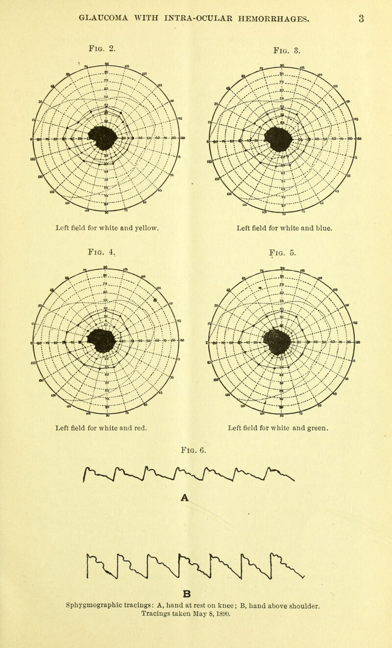 Fig. 2. Fig. 3. Left field for white and yellow. Left field for white and blue. Fig. 5. ...jis / • >,.-V- \\V e—!»•->6a--.70--lao-lao A'W T-^-^' >:^'V />.. Left field for white and red. Left field for white and green. Fig. 6. Sphygmographic tracings: A, hand at rest on knee; B, hand above shoulder. Tracings taken May 8,1890.