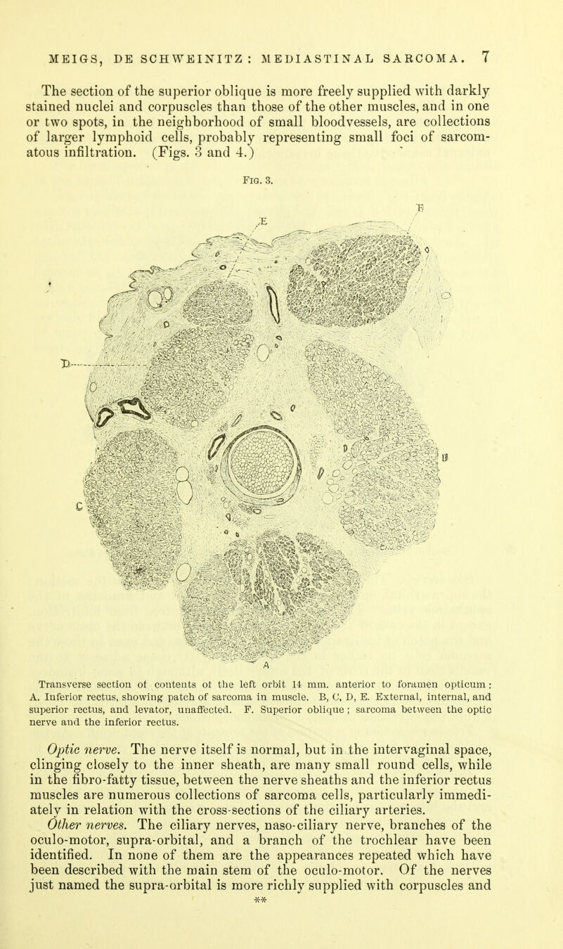 The section of the superior oblique is more freely supplied with darkly stained nuclei and corpuscles than those of the other muscles, and in one or two spots, in the neighborhood of small bloodvessels, are collections of larger lymphoid cells, probably representing small foci of sarcom- atous infiltration. (Figs. 3 and 4.) Fig. 3. ..E Transverse section of contents ot the left orbit 14 mm. anterior to foramen opticum : A. Inferior rectus, showing patch of sarcoma in muscle. B, C, D, E. External, internal, and superior rectus, and levator, unaffected. F. Superior oblique ; sarcoma between the optic nerve and the inferior rectus. Optic nerve. The nerve itself is normal, but in the intervaginal space, clinging closely to the inner sheath, are many small round cells, while in the fibro-fatty tissue, between the nerve sheaths and the inferior rectus muscles are numerous collections of sarcoma cells, particularly immedi- ately in relation with the cross-sections of the ciliary arteries. Other nerves. The ciliary nerves, naso-ciliary nerve, branches of the oculo-motor, supra-orbital, and a branch of the trochlear have been identified. In none of them are the appearances repeated which have been described with the main stem of the oculo-motor. Of the nerves just named the supra-orbital is more richly supplied with corpuscles and