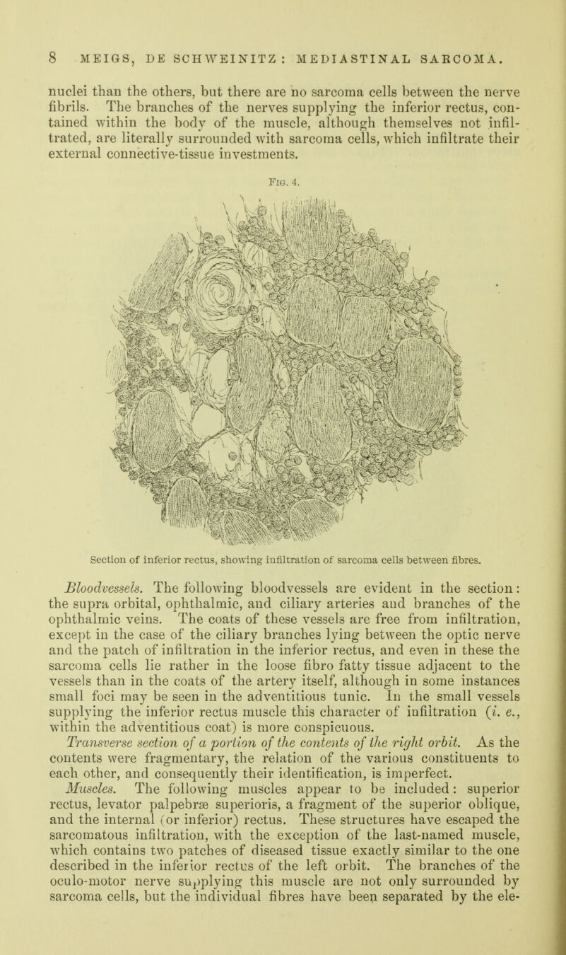 nuclei than the others, but there are no sarcoma cells between the nerve fibrils. The branches of the nerves supplying the inferior rectus, con- tained within the body of the muscle, although themselves not infil- trated, are literally surrounded with sarcoma cells, which infiltrate their external connective-tissue investments. Fig. 4. Section of inferior rectus, showing infiltration of sarcoma cells between fibres. Bloodvessels. The following bloodvessels are evident in the section: the supra orbital, ophthalmic, and ciliary arteries and branches of the ophthalmic veins. The coats of these vessels are free from infiltration, except in the case of the ciliary branches lying between the optic nerve and the patch of infiltration in the inferior rectus, and even in these the sarcoma cells lie rather in the loose fibro fatty tissue adjacent to the vessels than in the coats of the artery itself, although in some instances small foci may be seen in the adventitious tunic. In the small vessels supplying the inferior rectus muscle this character of infiltration (^. e., within the adventitious coat) is more conspicuous. Transverse section of a portion of the contents of the right orbit. As the contents were fragmentary, the relation of the various constituents to each other, and consequently their identification, is imperfect. Muscles. The following muscles appear to be included : superior rectus, levator palpebrse superioris, a fragment of the superior oblique, and the internal (or inferior) rectus. These structures have escaped the sarcomatous infiltration, with the exception of the last-named muscle, which contains two patches of diseased tissue exactly similar to the one described in the inferior rectus of the left orbit. The branches of the oculo-motor nerve supplying this muscle are not only surrounded by sarcoma cells, but the individual fibres have been separated by the ele-