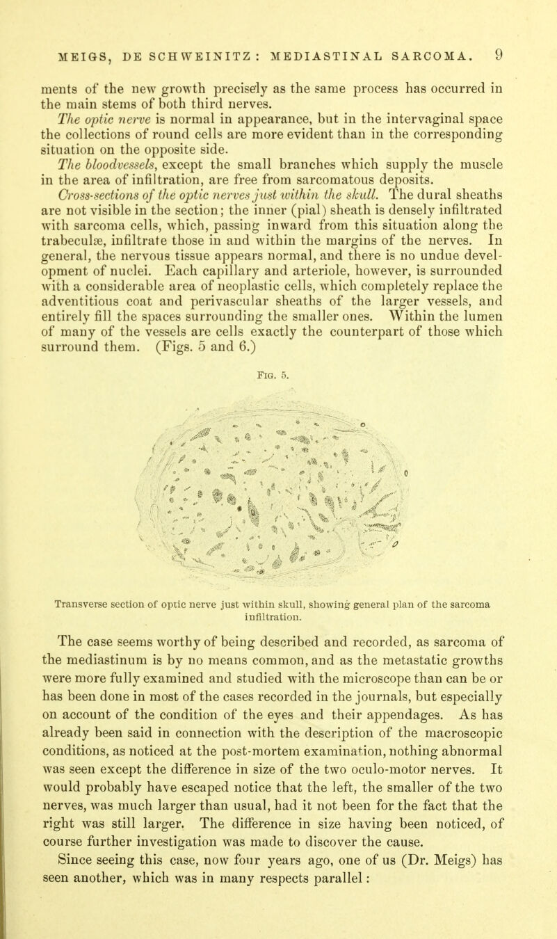 ments of the new growth precisely as the same process has occurred in the main stems of both third nerves. The optic nerve is normal in appearance, but in the intervaginal space the collections of round cells are more evident than in the corresponding situation on the opposite side. The bloodvessels, except the small branches which supply the muscle in the area of infiltration, are free from sarcomatous deposits. Cross-sections of the optic nerves just ivithin the skull. The dural sheaths are not visible in the section; the inner (pial) sheath is densely infiltrated with sarcoma cells, which, passing inward from this situation along the trabeculce, infiltrate those in and within the margins of the nerves. In general, the nervous tissue appears normal, and there is no undue devel- opment of nuclei. Each capillary and arteriole, however, is surrounded with a considerable area of neoplastic cells, which completely replace the adventitious coat and perivascular sheaths of the larger vessels, and entirely fill the spaces surrounding the smaller ones. Within the lumen of many of the vessels are cells exactly the counterpart of those which surround them. (Figs. 5 and 6.) Fig. 5. ' i *i ' ' I < • ft Transverse section of optic nerve just within skull, showing general plan of the sarcoma infiltration. The case seems worthy of being described and recorded, as sarcoma of the mediastinum is by no means common, and as the metastatic growths were more fully examined and studied with the microscope than can be or has been done in most of the cases recorded in the journals, but especially on account of the condition of the eyes and their appendages. As has already been said in connection with the description of the macroscopic conditions, as noticed at the post-mortem examination, nothing abnormal was seen except the difference in size of the two oculo-motor nerves. It would probably have escaped notice that the left, the smaller of the two nerves, was much larger than usual, had it not been for the fact that the right was still larger. The difference in size having been noticed, of course further investigation was made to discover the cause. Since seeing this case, now four years ago, one of us (Dr. Meigs) has seen another, which was in many respects parallel: