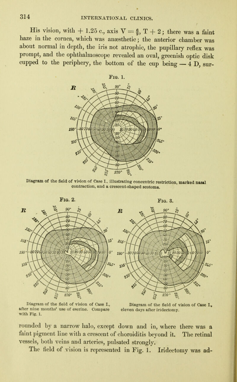 His vision, with + 1.25 a, axis V = f, T + 2; there was a faint haze in the cornea, which was anaesthetic; the anterior chamber was about normal in depth, the iris not atrophic, the pupillary reflex was prompt, and the ophthalmoscope revealed an oval, greenish optic disk cupped to the periphery, the bottom of the cup being — 4 D, sur- Fiq. l. Diagram of the field of vision of Case I., illustrating concentric restriction, marked nasal contraction, and a crescent-shaped scotoma. Fig. 2. y1G. 3. Diagram of the field of vision of Case L, Diagram of the field of vision of Case L, after nine months' use of eserine. Compare eleven days after iridectomy, with Fig. 1. rounded by a narrow halo, except down and in, where there was a faint pigment line with a crescent of choroiditis beyond it. The retinal vessels, both veins and arteries, pulsated strongly. The field of vision is represented in Fig. 1. Iridectomy was ad-