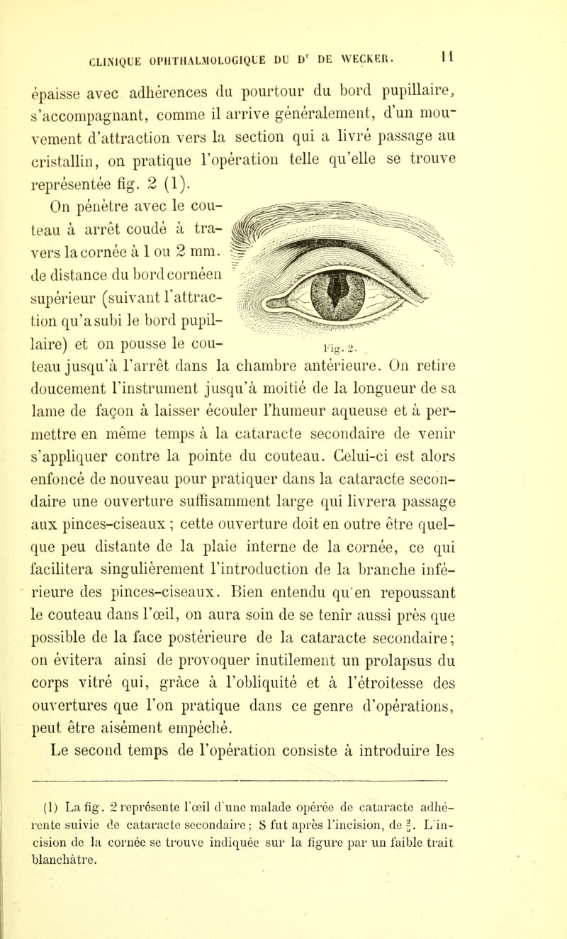 épaisse avec adhérences du pourtour du bord pupillaire, s'accompagnant, comme il arrive généralement, d'un mou- vement d'attraction vers la section qui a livré passage au cristallin, on pratique l'opération telle qu'elle se trouve représentée fig. 2 (1). On pénètre avec le cou- teau à arrêt coudé à tra- « vers la cornée à 1 ou 2 mm. de distance du bord cornéen supérieur (suivant l'attrac- tion qu'a subi le bord pupil- laire) et on pousse le cou- teau jusqu'à l'arrêt dans la chambre antérieure. On retire doucement l'instrument jusqu'à moitié de la longueur de sa lame de façon à laisser écouler l'humeur aqueuse et à per- mettre en même temps à la cataracte secondaire de venir s'appliquer contre la pointe du couteau. Celui-ci est alors enfoncé de nouveau pour pratiquer dans la cataracte secon- daire une ouverture suffisamment large qui livrera passage aux pinces-ciseaux ; cette ouverture doit en outre être quel- que peu distante de la plaie interne de la cornée, ce qui facilitera singulièrement l'introduction de la branche infé- ' rieure des pinces-ciseaux. Bien entendu qu en repoussant le couteau dans l'œil, on aura soin de se tenir aussi près que possible de la face postérieure de la cataracte secondaire ; on évitera ainsi de provoquer inutilement un prolapsus du corps vitré qui, grâce à l'obliquité et à l'étroitesse des ouvertures que l'on pratique dans ce genre d'opérations, peut être aisément empêché. Le second temps de l'opération consiste à introduire les (1) La fig. 2 représente l'œil d'une malade opérée de cataracte adhé- rente suivie de cataracte secondaire ; S fut après l'incision, de f. L'in- cision de la cornée se trouve indiquée sur la figure par un faible trait blanchâtre.