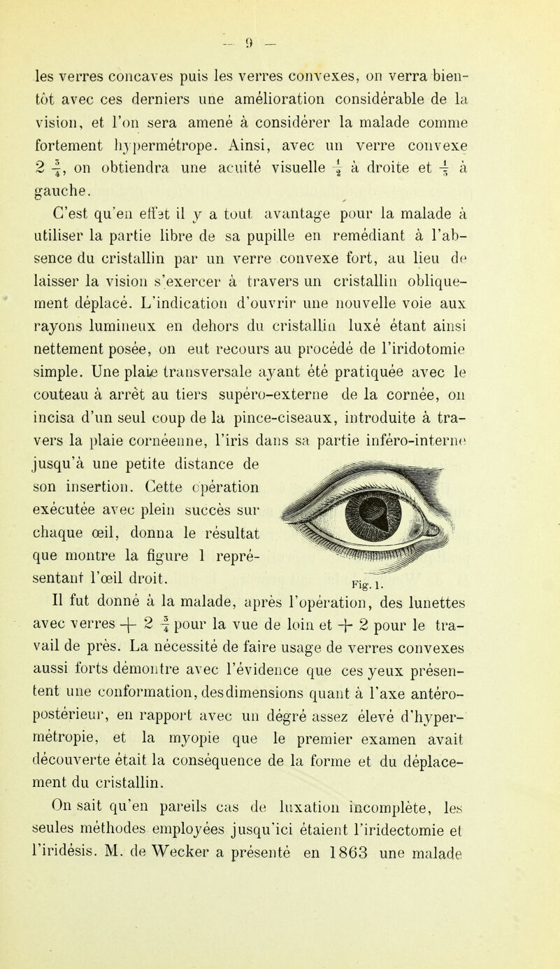 les verres concaves puis les verres convexes, on verra bien- tôt avec ces derniers une amélioration considérable de la vision, et l'on sera amené à considérer la malade comme fortement hypermétrope. Ainsi, avec un verre convexe 2 4, on obtiendra une acuité visuelle \ à droite et \ à gauche. C'est qu'en effet il y a tout avantage pour la malade à utiliser la partie libre de sa pupille en remédiant à l'ab- sence du cristallin par un verre convexe fort, au lieu de laisser la vision s'exercer à travers un cristallin oblique- ment déplacé. L'indication d'ouvrir une nouvelle voie aux rayons lumineux en dehors du cristallin luxé étant ainsi nettement posée, on eut recours au procédé de l'iridotomie simple. Une plaie transversale ayant été pratiquée avec le couteau à arrêt au tiers supéro-externe de la cornée, on incisa d'un seul coup de la pince-ciseaux, introduite à tra- vers la plaie cornéenne, l'iris dans sa partie inféro-interne jusqu'à une petite distance de son insertion. Cette opération exécutée avec plein succès sur chaque œil, donna le résultat que montre la figure 1 repré- sentant l'œil droit. Il fut donné à la malade, après l'opération, des lunettes avec verres -f 2 f pour la vue de loin et + 2 pour le tra- vail de près. La nécessité de faire usage de verres convexes aussi forts démontre avec l'évidence que ces yeux présen- tent une conformation, des dimensions quant à l'axe antéro- postérieur, en rapport avec un dégré assez élevé d'hyper- métropie, et la myopie que le premier examen avait découverte était la conséquence de la forme et du déplace- ment du cristallin. On sait qu'en pareils cas de luxation incomplète, les seules méthodes employées jusqu'ici étaient l'iridectomie el l'iridésis. M. de Wecker a présenté en 1863 une malade