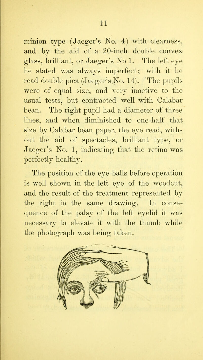 minion type (Jaeger's No. 4) with clearness, and by the aid of a 20-inch double convex glass, brilliant, or Jaeger's No 1. The left eye he stated was always imperfect; with it he read double pica (Jaeger's No. 14). The ]Dupils were of equal size, and very inactive to the usual tests, but contracted well with Calabar bean. The right pupil had a diameter of three lines, and when diminished to one-half that size by Calabar bean paper, the eye read, with- out the aid of spectacles, brilliant type, or Jaeger's No. 1, indicating that the retina was perfectly healthy. The position of the eye-balls before operation is well shown in the left eye of the woodcut, and the result of the treatment represented by the right in the same drawing. In conse- quence of the palsy of the left eyelid it was necessary to elevate it with the thumb while the photograph was being taken.