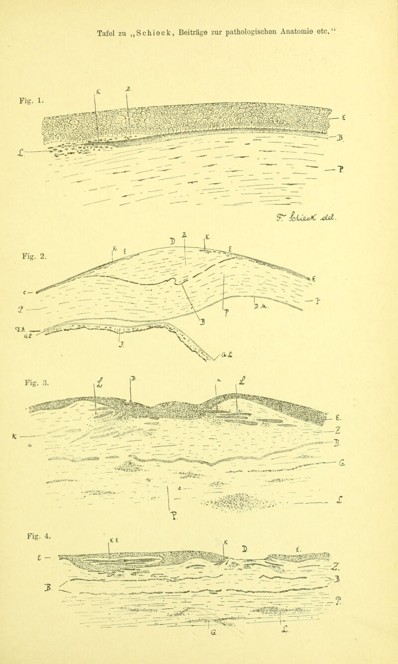 Tafel zu „Schieck, Beiträge zur pathologischen Anatomie etc.