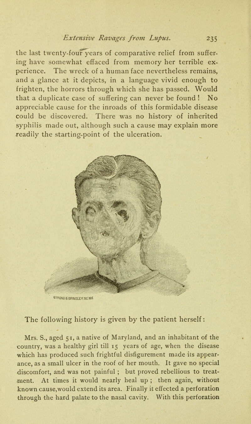 the last twenty-four years of comparative relief from suffer- ing have somewhat effaced from memory her terrible ex- perience. The wreck of a human face nevertheless remains, and a glance at it depicts, in a language vivid enough to frighten, the horrors through which she has passed. Would that a duplicate case of suffering can never be found ! No appreciable cause for the inroads of this formidable disease could be discovered. There was no history of inherited syphilis made out, although such a cause may explain more readily the starting-point of the ulceration. STRONG & BRINSLEY.SC. NV. The following history is given by the patient herself: Mrs. S., aged 51, a native of Maryland, and an inhabitant of the country, was a healthy girl till 15 years of age, when the disease which has produced such frightful disfigurement made its appear- ance, as a small ulcer in the roof of her mouth. It gave no special discomfort, and was not painful ; but proved rebellious to treat- ment. At times it would nearly heal up ; then again, without known cause,would extend its area. Finally it effected a perforation through the hard palate to the nasal cavity. With this perforation