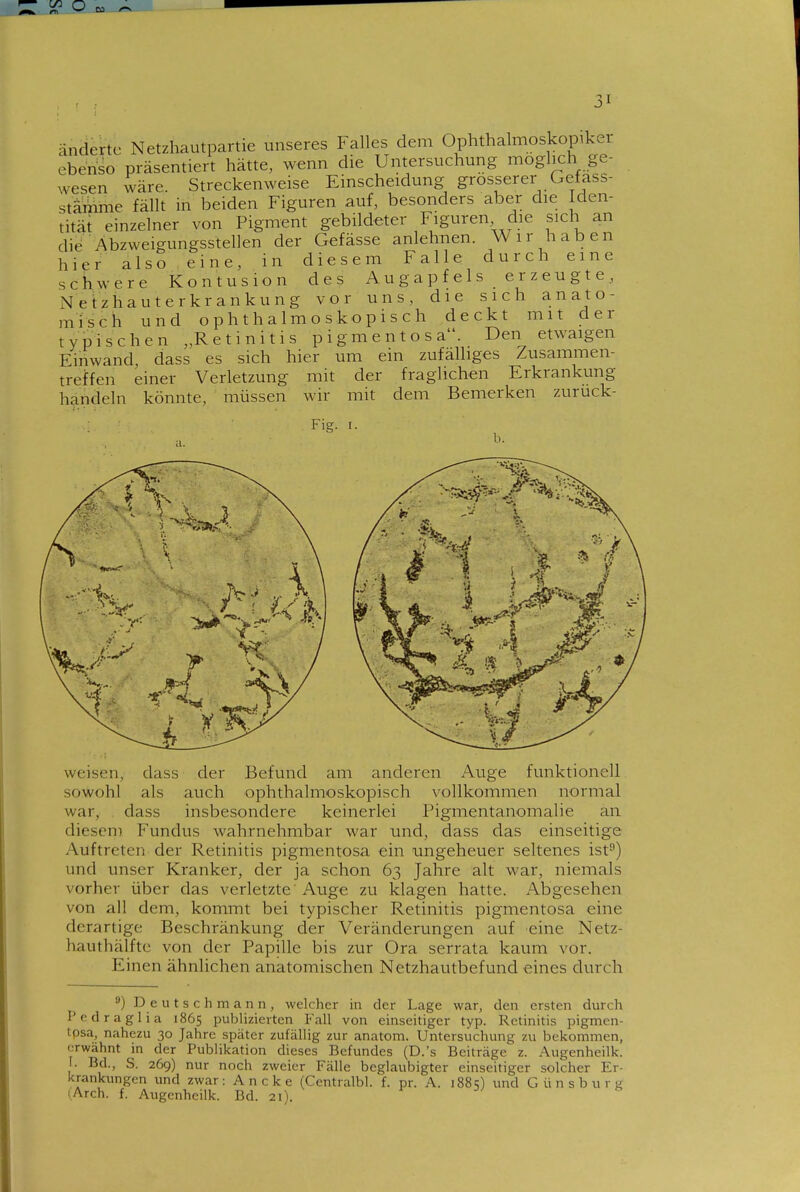 änderte Netzhautpartie unseres Falles dem Ophthalmoskopikei ebenso präsentiert hätte, wenn die Untersuchung möglich ge- wesen wäre. Streckenweise Einscheidung grosserer Gefass- stämme fällt in beiden Figuren auf, besonders aber die Iden- tität einzelner von Pigment gebildeter Figuren die sich an die'Abzweigungsstellen der Gefässe anlehnen. Wir haben hier also eine, in diesem Falle durch eine schwere Kontusion des Au g a p f e 1 s e r zeu g t e Netzhauterkrankung vor uns, die sich anato- misch und ophthalmoskopisch deckt mit der typischen „Retinitis pigmentosa. Den etwaigen Einwand, dass es sich hier um ein zufälhges Zusammen- treffen einer Verletzung mit der fraglichen Erkrankung handeln könnte, müssen wir mit dem Bemerken zuruck- Fig. I. weisen, dass der Befund am anderen Auge funktionell sowohl als auch ophthalmoskopisch vollkommen normal war, dass insbesondere keinerlei Pigmentanomalie an diesem Fundus wahrnehmbar war und, dass das einseitige Auftreten der Retinitis pigmentosa ein ungeheuer seltenes ist^) und unser Kranker, der ja schon 63 Jahre alt war, niemals vorher über das verletzte Auge zu klagen hatte. Abgesehen von all dem, kommt bei typischer Retinitis pigmentosa eine derartige Beschränkung der Veränderungen auf eine Netz- hauthälfte von der Papille bis zur Ora serrata kaum vor. Einen ähnlichen anatomischen Netzhautbefund eines durch ) D e u t s c h m a n n , welcher in der Lage war, den ersten durch Pedraglia 1865 publizierten Fall von einseitiger typ. Retinitis pigmen- tpsa, nahezu 30 Jahre später zufällig zur anatom. Untersuchung zu bekommen, erwähnt in der Publikation dieses Befundes (D.'s Beiträge z. Augenheilk. I. Bd., S. 269) nur noch zweier Fälle beglaubigter einseitiger solcher Er- krankungen und zwar: Ancke (Centralbl. f. pr. A. 1885) und Günsburg (.Arch. f. Augenheilk. Bd. 21).