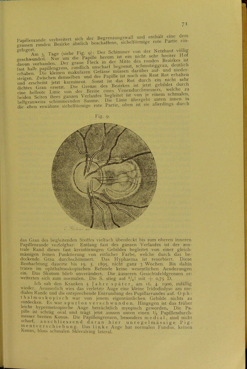 ^''■^Am . Taec (siehe Fig. 9): Der Schimmer von der Netzhaut völhg fa^Mlb ^-^pmengros: Sn'dUci ^^.'sciarf'iegJenzt, schmut.iggrau, deuthch c'haben dI^ kTefnerm^^^^^^ Gefässe müssen darüber au - und meder- s eite^ Z v sehen demselben und der Papille ist noch em Rest Rot erhahen unTersche nrjetzt karminrot. Sonst ist das Rot durch ein nicht sehr Stes Grau ersetzt. Die Grenze des Bezirkes ist jetzt gebildet durch eine helk^tt Sme von der Breite eines Venendurchmessers, .velche .u beiden sSen ihres ganzen Verlaufes begleitet ist von je einem schmalen, helTgrauwe SS schimmernden Saume. Die Linie übergeht unten innen m d'c oben erwähnte sichelförmige rote Partie, oben ist sie allerdings duich Fig. 9. das Grau des begleitenden Stoffes vielfach überdeckt bis zum oberen inneren Papillenrande verfolgbar. Entlang fast des ganzen Verlaufes ist der zen- trale Rand dieses fast kreisförmigen Gebildes begleitet von einer gleich- massigen feinen Punktierung von rötlicher Farbe, welche durch das be- deckende Grau durchschimmert. Das Hyphaema ist resorbiert. Diese Beobachtung dauerte bis 19. 5. 1895, nicht ganz 3 Wochen. Bis dahin traten im ophthalmoskopischen Befunde keine wesentlichen Aenderungen ein. Das Skotom blieb unverändert. Die äusseren Gesichtsfeldgrenzen er- weiterten sich zum normalen. Die S. stieg auf /g! mit -f- 0,75 D. Ich sah den Kranken 5 Jahre später, am 16. 4. 1900, zufällig wieder. .Aeusserlich wies das verletzte Auge eine kleine Iridodiolj'sc am me- dialen Rande und die entsprechende Entrundung des Pupillarrandes auf. Oph- thalmoskopisch war von jenem eigentümlichen Gebilde nichts zu entdecken. Es war spurlos verschwunden. Hingegen ist das früher leicht hypcrmetropische Auge beträchtlich myopisch geworden. Die Pa- pille ist schräg oval und trägt jetzt aussen unten einen 1/2 Papillendurch- mcsser breiten Konus. Die Papillengrenzen, besonders m e d i a 1, sind nicht scharf, anschliessend daran hier unrcgelm,ässige Pig- ment v e r s c h i e b u n g. Das lin,ke Auge hat normalen Fundus, keinen Konus, bloss schmalen Skleralring lateral.