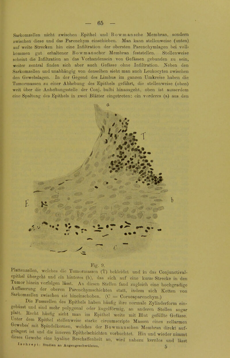 Sarkomzellen nicht zwischen Epithel und Bowmansche Membran, sondern zwischen diese und das Parenchym einschieben. Man kann stellenweise (unten), auf weite Strecken hin eine Infiltration der obersten Parenchymlagen bei voll- kommen gut erhaltener Bowm an scher Membran feststellen. Stellenweise scheint die Infiltration an das Vorhandensein von Gefässen gebunden zu sein, weiter zentral finden sich aber auch Gefässe ohne Infiltration. Neben den Sarkomzellen und unabhängig von denselben sieht man auch Leukocyten zwischen den Gewebslagen. In der Gegend des Limbus im ganzen Umkreise haben die Tumormassen zu einer Abhebung des Epithels geführt, die stellenweise (oben) weit über die Anheftungsstelle der Conj. bulbi hinausgeht, oben ist ausserdem eine Spaltung des Epithels in zwei Blätter eingetreten: ein vorderes (a) aus den a * V' Fig. 9. Plattenzellen, welches diu Tumormassen (T) bekleidet und in das Conjunctival- epithel übergeht und ein hinteres (b), das sich auf eine kurze Strecke in den Tumor hinein verfolgen lässt. An diesen Stellen fand zugleich eine hochgradige Auffaserung der oberen Parcnchymschichteri statt, indem sich Kotten von Sarkomzellen zwischen sie hineinschoben. (0 = Cornoaparcnchym.) Die Fusszcllen des Epithels haben häufig ihre normale Zylinderform ein- gebest und sind mehr polygonal oder kugelförmig, an anderen Stollen sogar Platt. Recht häufig sieht man im Epithel weite mit Blut gefüllte Gefässe. Unter dem Epithel stellenweise starke circumscriptc Massen eines zellarmen Gewebes' mit Spindelkernen, welches der Bowmanschen Membran direkt auf- gelagert ist und die inneren Epithelschichten vorbuchtet. Hin und wieder nimmt dieses Gewebe eine hyaline Beschaffenheit an, wird nahezu kernlos und lässt I s o h t e y t: Studien an AugengeachwülBten. 5