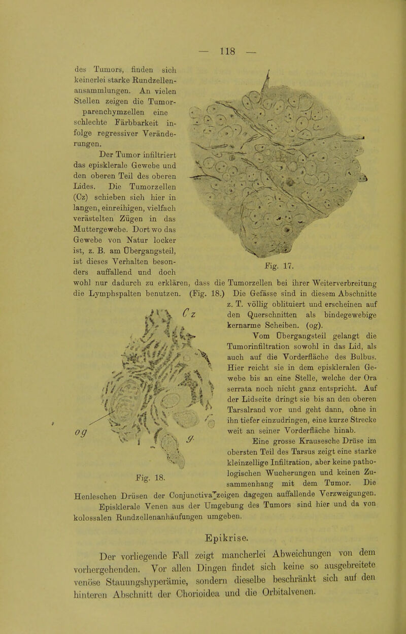 / dos Tumors, finden sich keinerlei starke Rundzellen- ansaminlungen. An vielen Stellen zeigen die Tumor- -iCt^fv/ ( ' parenchymzellen eine • ^isjfei • • . schlechte Färbbarkeit in- 1^ 'V. . '^Cl V (*f folge regressiver Verände- P .* ' ''»-^^r:' C^--*»88^- « Der Tumor infiltriert .^■5*2~T*rs*' ^^v^jt^^^i^r5*^*) das episklerale Gewebe und \-MlT*Vk ^C'^m^ r / ' - 1 den oberen Teil des oberen -scr^«^'  • •' ,\ . '; ^ \ Lides. Die Tumorzellen ' / ' V^-vXv^ ' (Cz) schieben sich hier in *if>c^A<*V rf|«Sk£. %, . langen, einreihigen, vielfach ./',''  ,*1 -v> ' * verästelten Zügen in das ' Muttergewebe. Dort wo das # Gewebe von Natur locker . - ist, z.B. am Übergangsteil, Xv -■ V ist dieses Verhalten beson- cv in rig. 17. ders auffallend und doch wohl nur dadurch zu erklären, dass die Tumorzellen bei ihrer Weiterverbreitung die Lymphspalten benutzen. (Fig. 18.) Die Gefässe sind in diesem Abschnitte z. T. völlig oblituiert und erscheinen auf »■/ ' V ^z ^en Q,uerschnitten als bindegewebige 5 i . ^ kernarme Scheiben, (og). • Vom Übergangsteil gelangt die Tumorinfiltration sowohl in das Lid, als auch auf die Vorderflächo des Bulbus. Hier reicht sie in dem episkleralen Ge- webe bis an eine Stelle, welche der Ora serrata noch nicht ganz entspricht. Auf der Lidseite dringt sie bis an den oberen Tarsalrand vor und geht dann, ohne in ihn tiefer einzudringen, eine kurze Strecke weit an seiner Vorderfläche hinab. Eine grosse Krausesche Drüse im obersten Teil des Tarsus zeigt eine starke kleinzellige Infiltration, aber keine patho- „. logischen Wucherungen und keinen Zu- sammenhang mit dem Tumor. Die Henleschen Drüsen der Oonjunctiva^zoigen dagegen auffallende Verzweigungen. Episklerale Venen aus der Umgebung des Tumors sind hier und da von kolossalen Rundzellenanhäufungen umgeben. Epikrise. Der vorliegende Fall zeigt mancherlei Abweichungen von dem vorhergehenden. Vor allen Dingen findet sich keine so ausgebreitete venöse Stauungshyperämie, sondern dieselbe beschränkt sich auf den hinteren Abschnitt der Chorioidea und die Orbitalvenen.
