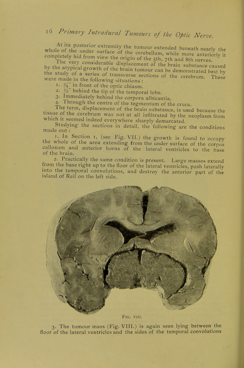 At its posterior extremity the tumour extended beneath nearlv rh. 1 '^'^^'^ °f cerebellum, while more anterS-lv it completely h.d from v.ew the origin of the 5th 7th and 8th nervT ^ The very considerable displacement of the brain substance caused 'he s ud? ofI%T'' 11' '^^^ '^^ demonstrated best by the study of a series of transverse sections of the cerebrum These were made in the following situations : ^^rum. 1 nese 1. in front of the optic chiasm. 2. j4 behind the tip of the temporal lobe. 3. Immediately behind the corpora albicantia. 4. Through the centre of the tegmentum of the crura. Ihe term, displacement of the brain substance, is used because the tissue ot the cerebrum was not at all infiltrated by the neoplasm from which It seemed indeed everywhere sharply demarcated. Studying the sections in detail, the following are the conditions made out : .u ^u^, ^f'^^'O '> (see Fig. VII.) the growth is found to occupy the whole of the area extending from the under surface of the corpus callosum and anterior horns of the lateral ventricles to the base of the brain. 2. Practically the same condition is present. Large masses extend from the base right up to the floor of the lateral ventricles, push laterally into the temporal convolutions, and destroy the anterior p^rt of the island of Reil on the left side. 3. The tumour mass (Fig. VIII.) is again seen lying between the floor of the lateral ventricles and the sides of the temporal convolutions