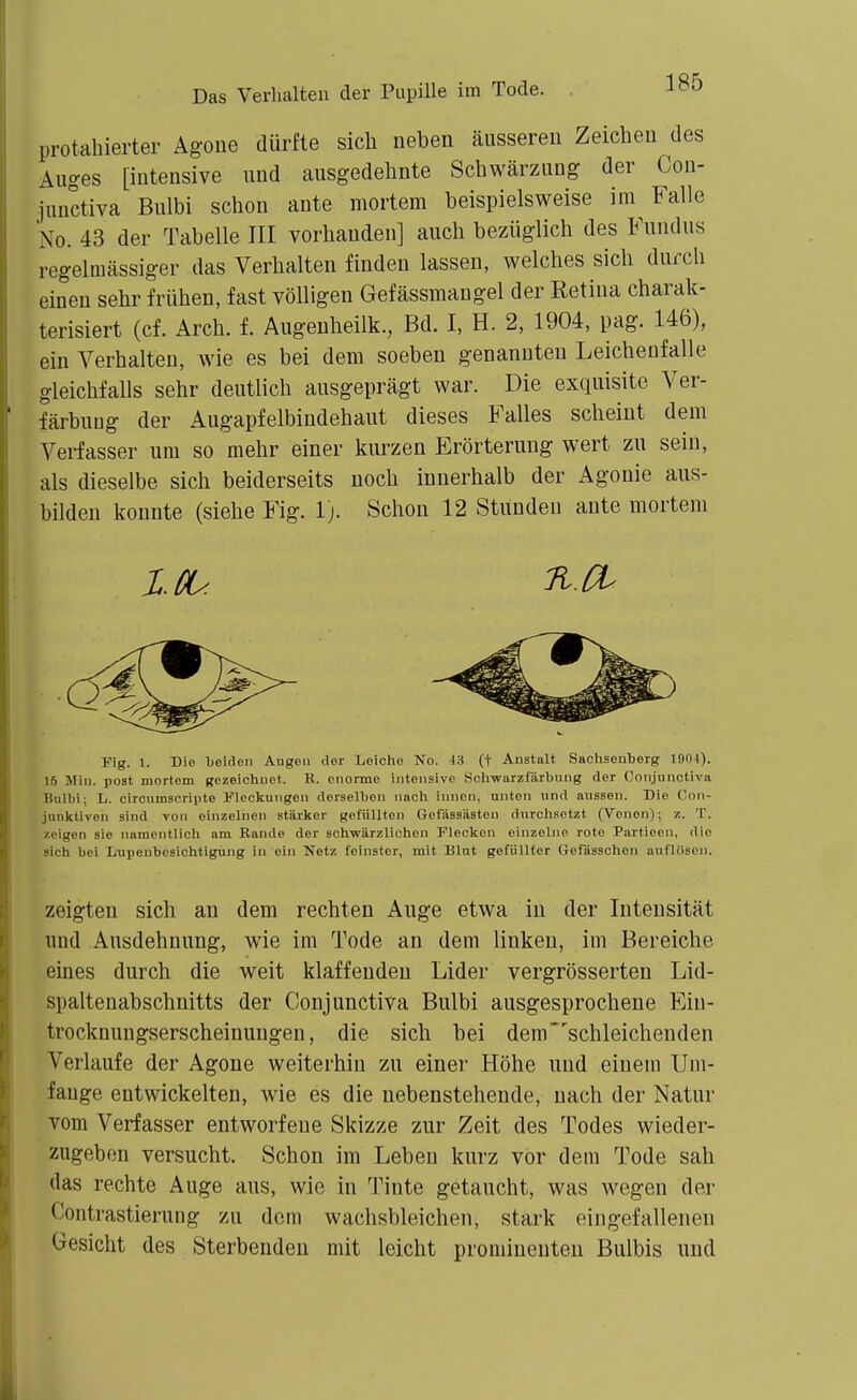 protahierter Agone dürfte sich neben äusseren Zeichen des Auges [intensive und ausgedehnte Schwärzung der Con- junctiva Bulbi schon ante mortem beispielsweise im Falle No. 43 der Tabelle III vorhanden] auch bezüglich des Fundus regelmässiger das Verhalten finden lassen, welches sich durch einen sehr frühen, fast völligen Gefässmangel der Retina charak- terisiert (cf. Arch. f. Augeuheilk., Bd. I, H. 2, 1904, pag. 146), ein Verhalten, wie es bei dem soeben genannten Leichenfalle gleichfalls sehr deutlich ausgeprägt war. Die exquisite Ver- färbung der Augapfelbindehaut dieses Falles scheint dem Verfasser um so mehr einer kurzen Erörterung wert zu sein, als dieselbe sich beiderseits noch innerhalb der Agonie aus- bilden konnte (siehe Fig. 1). Schon 12 Stunden ante mortem Fig. 1. Die beiden Augen der Leicho No. 43 (f Anstalt Sachsenberg 1901). 16 Min. post mortem gezeichnet. R. enorme intensive Sclmurzfärbung der Conjunctiva Bulbi; L. circumscrivte Fleckungen derselben nach innen, unten und aussen. Die Con- junktiven sind von einzelnen stärker gefüllten Gefässästen durchsetzt (Venen); z. T. zeigen sie namentlich ara Rande der schwärzlichen Flecken einzelne rot© Partioen, die sich bei Inipeubcsichtigung in ein Netz feinster, mit Blut gefüllter Gofässchen auflösen. zeigten sich an dem rechten Auge etwa in der Intensität und Ausdehnung, wie im Tode an dem linken, im Bereiche eines durch die weit klaffenden Lider vergrösserten Lid- spaltenabschnitts der Conjunctiva Bulbi ausgesprochene Ein- trocknungserscheinungen, die sich bei dem'schleicheuden Verlaufe der Agone weiterhin zu einei- Höhe und einem Um- fange entwickelten, wie es die nebenstehende, nach der Natur vom Verfasser entworfene Skizze zur Zeit des Todes wieder- zugeben versucht. Schon im Leben kurz vor dem Tode sah das rechte Auge aus, wie in Tinte getaucht, was wegen der Contrastieruug zu dem wachsbleichen, stark eingefallenen Gesicht des Sterbenden mit leicht prominenten Bulbis und