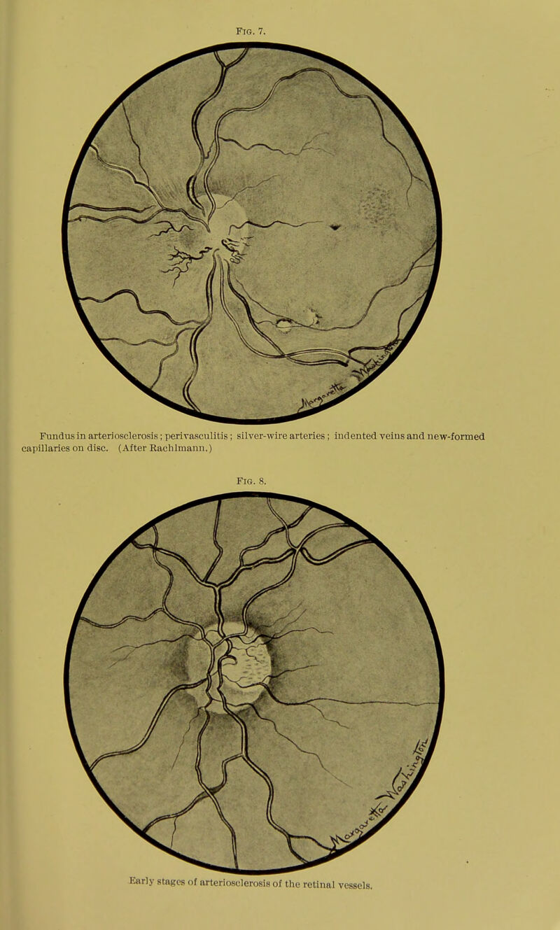 Fig. 7. Fundus in arteriosclerosis; perivasculitis; silver-wire arteries; indented veins and new-formed capillaries on disc. (After Raclilmann.) Fig. 8. Early stages of arteriosclerosis of the retinal vessels.