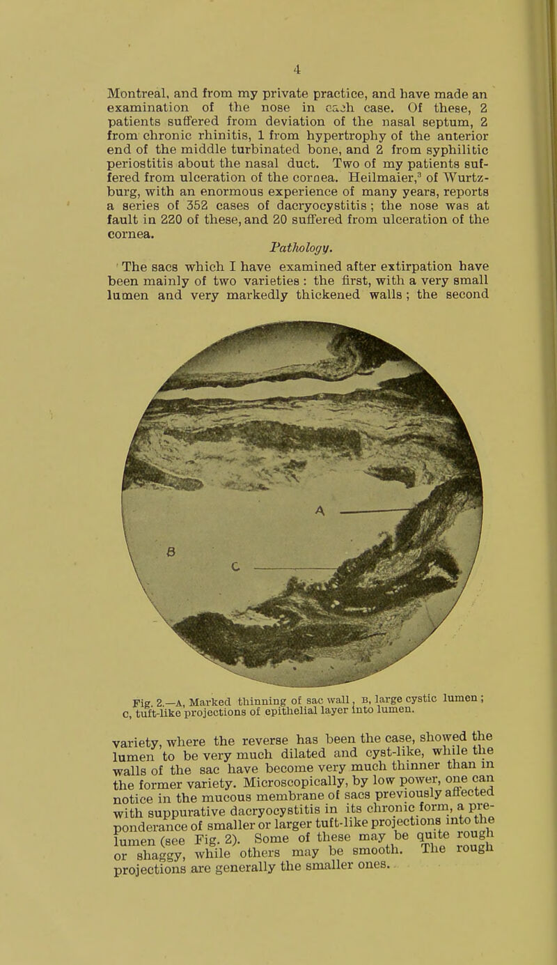 Montreal, and from my private practice, and have made an examination of the nose in cajh case. Of these, 2 patients suffered from deviation of the nasal septum, 2 from chronic rhinitis, 1 from hypertrophy of the anterior end of the middle turbinated bone, and 2 from syphilitic periostitis about the nasal duct. Two of my patients suf- fered from ulceration of the cornea. Heilmaier,3 of Wurtz- burg, with an enormous experience of many years, reports a series of 352 cases of dacryocystitis ; the nose was at fault in 220 of these, and 20 suffered from ulceration of the cornea. Patlwlogy. The sacs which I have examined after extirpation have been mainly of two varieties : the first, with a very small lumen and very markedly thickened walls ; the second 8 Fie 2 —A, Marked thinning of sac wall, b. large cystic lumen ; c, tuft-like projections of epithelial layer Into lumen. variety, where the reverse has been the case, showed the lumen to be very much dilated and cyst-like, while the walls of the sac have become very much thinner than in the former variety. Microscopically, by low power, one can notice in the mucous membrane of sacs previously affected with suppurative dacryocystitis in its chronic form, a pre- ponderance of smaller or larger tuft-like projections into the lumen (see Fig. 2). Some of these may be quite rough or shaggy, while others may be smooth. The rough projections are generally the smaller ones..