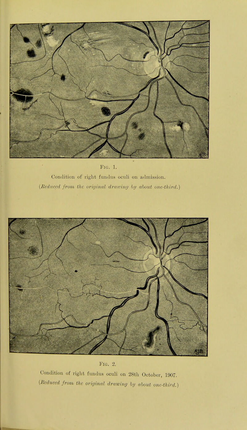 Condition of right fundus oculi on admission. [Reduced from the original drawing by about one-third.) Fig. 2. Condition of right fundus oculi on 28th October, 1907. (Reduced from the original drawing by about one-thin/.)