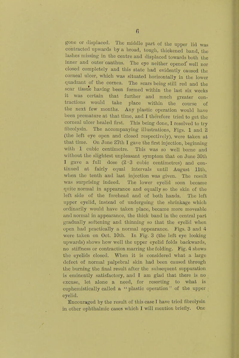 gone or displaced. The middle part of the upper lid waa contracted upwards by a broad, tough, thickened band, the lashes missing in the centre and displaced towards both the inner and outer canthus. The eye neither opened' well nor closed completely and this state had evidently caused the corneal ulcer, which was situated horizontally in the lower quadrant of the cornea. The scars being still red and the scar tissue having been formed within the last six weeks it was certain that further and much greater con- tractions would take place within the course of the next few months. Any plastic operation would have been premature at that time, and I therefore tried to get the corneal ulcer healed first. This being done, I resolved to try librolysin. The accompanying illustrations, Figs. 1 and 2 (the left eye open and closed respectively), were taken at that time. On June 27th I gave the first injection, beginning with 1 cubic centimetre. This was so well borne and without the slightest unpleasant symptom that on June 30th I gave a full dose (2 • 3 cubic centimetres) and con- tinued at fairly equal intervals until August 11th, when the tenth and last injection was given. The result was surprising indeed. The lower eyelid soon became quite normal in appearance and equally so the skin of the left side of the forehead and of both hands. The left upper eyelid, instead of undergoing the shrinkage which ordinarily would have taken place, became more moveable and normal in appearance, the thick band in the central part gradually softening and thinning so that the eyelid when open had practically a normal appearance. Figs. 3 and 4 were taken on Oct. 10th. In Fig. 3 (the left eye looking upwards) shows how well the upper eyelid folds backwards, no stiffness or contraction marring the folding. Fig. 4 shows the eyelids closed. When it is considered what a large defect of normal palpebral skin had been caused through the burning the final result after the subsequent suppuration is eminently satisfactory, and I am glad that there is no excuse, let alone a need, for resorting to what is euphemistically called a plastic operation of the upper eyelid. Encouraged by the result of this case I have tried fibrolysin in other ophthalmic cases which I will mention briefly. One