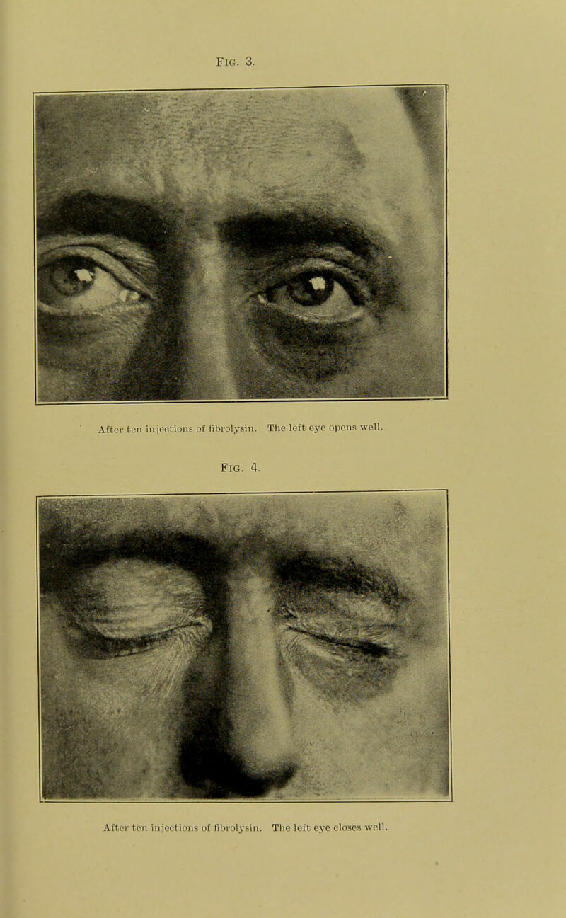 After ton injections of fibrolysin. The left eye closes well.