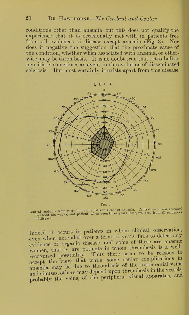 conditions other than anffiuiia, but this does not qualify the experience that it is occasionally met with in patients free from all evidences of disease except anaemia (Fig. 3). Nor does it negative the suggestion that tlie proximate cause of the condition, whether when associated with anaemia, or other- wise, may be thrombosis. It is no doubt true that retro-bulbar neuritis is sometimes an event in the evolution of disseminated sclerosis. But most certainly it exists apart from this disease. Indeed it occurs in patients in whom clmical observation, even when extended over a term of years, fails to detect any evidence of organic disease, and some of these are anaemic women, that is, are patients in whom thrombosis is a well- Tecoanised possibility. Thus there seem to be reasons to acceSt the view that while some ocular complications m anSa may be due to thrombosis of the intracranial veins and Minuses, others may depend upon thrombosis m the vessels probably the veins, of the peripheral visual apparatus, and